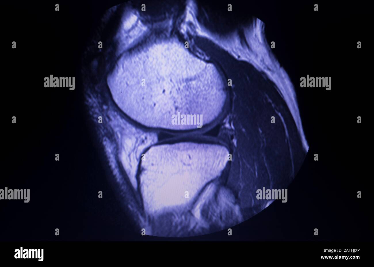 resonance imaging MRI knee posterior horn medial meniscus tear