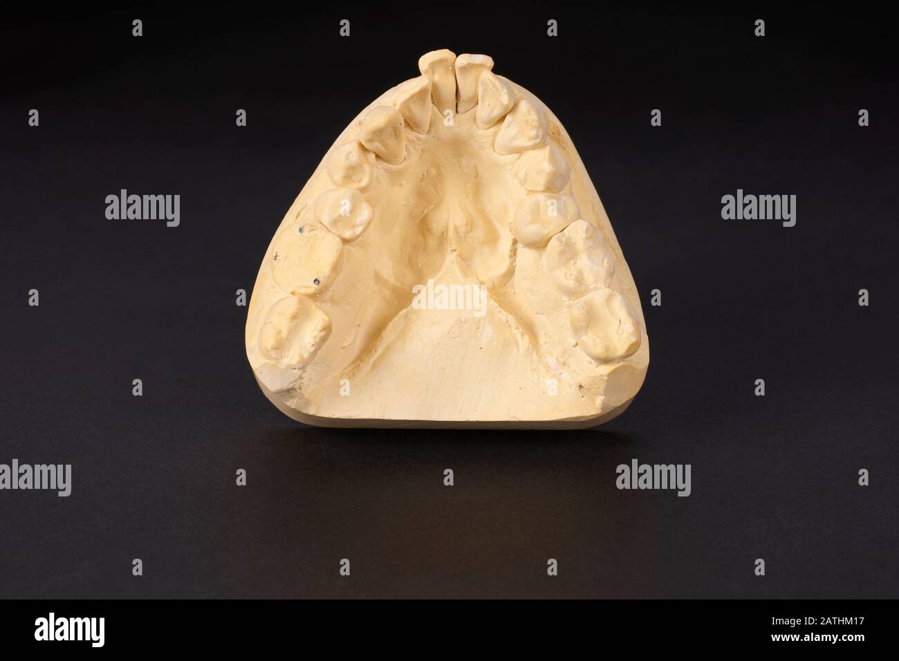 Plaster cast section of lower teeth with protruding incisors from middle-aged human male for producing a dental crown in companion upper teeth. Stock Photo