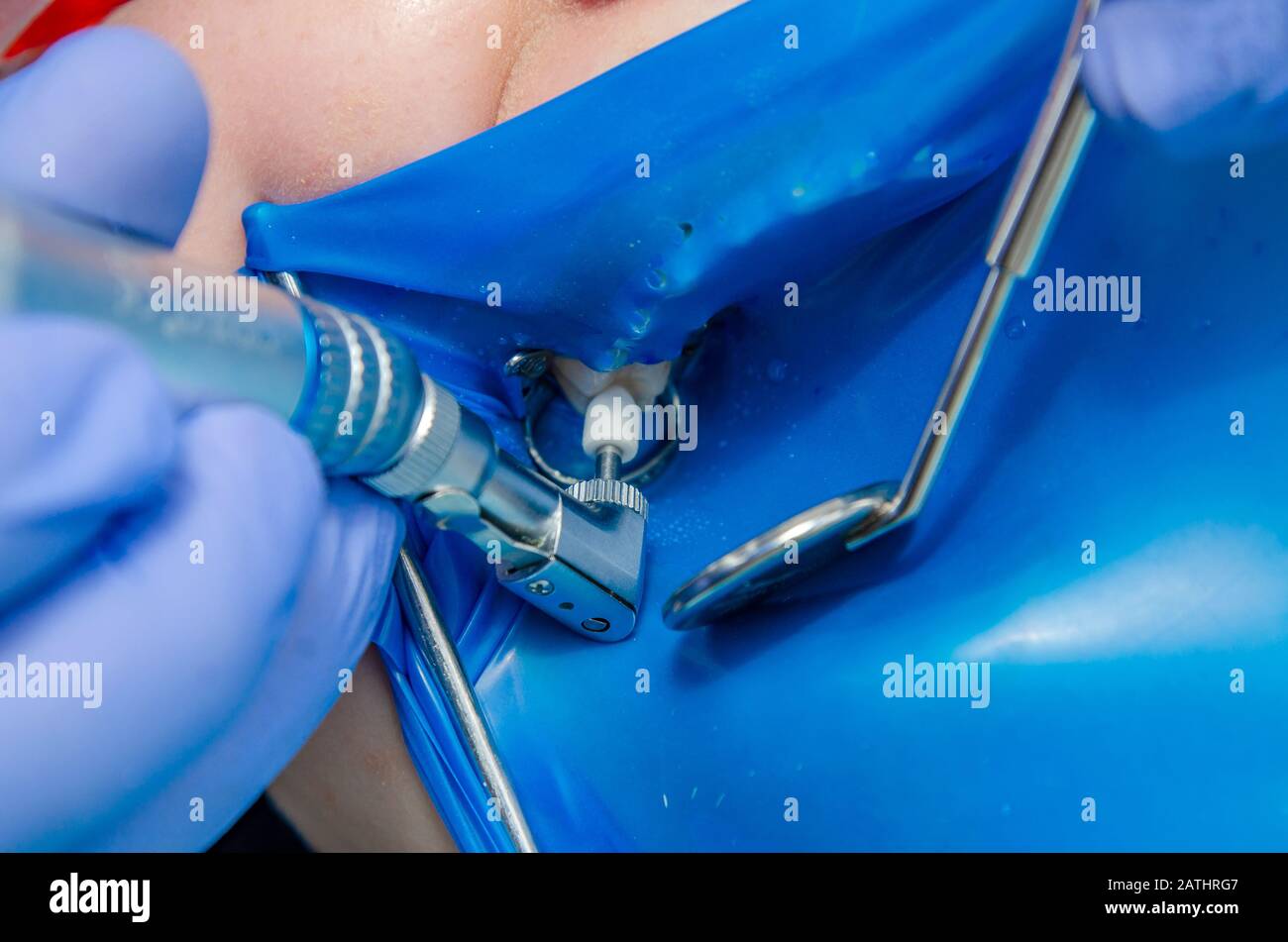 Tooth treatment in dentistry. The mouth is covered with a blue rubber