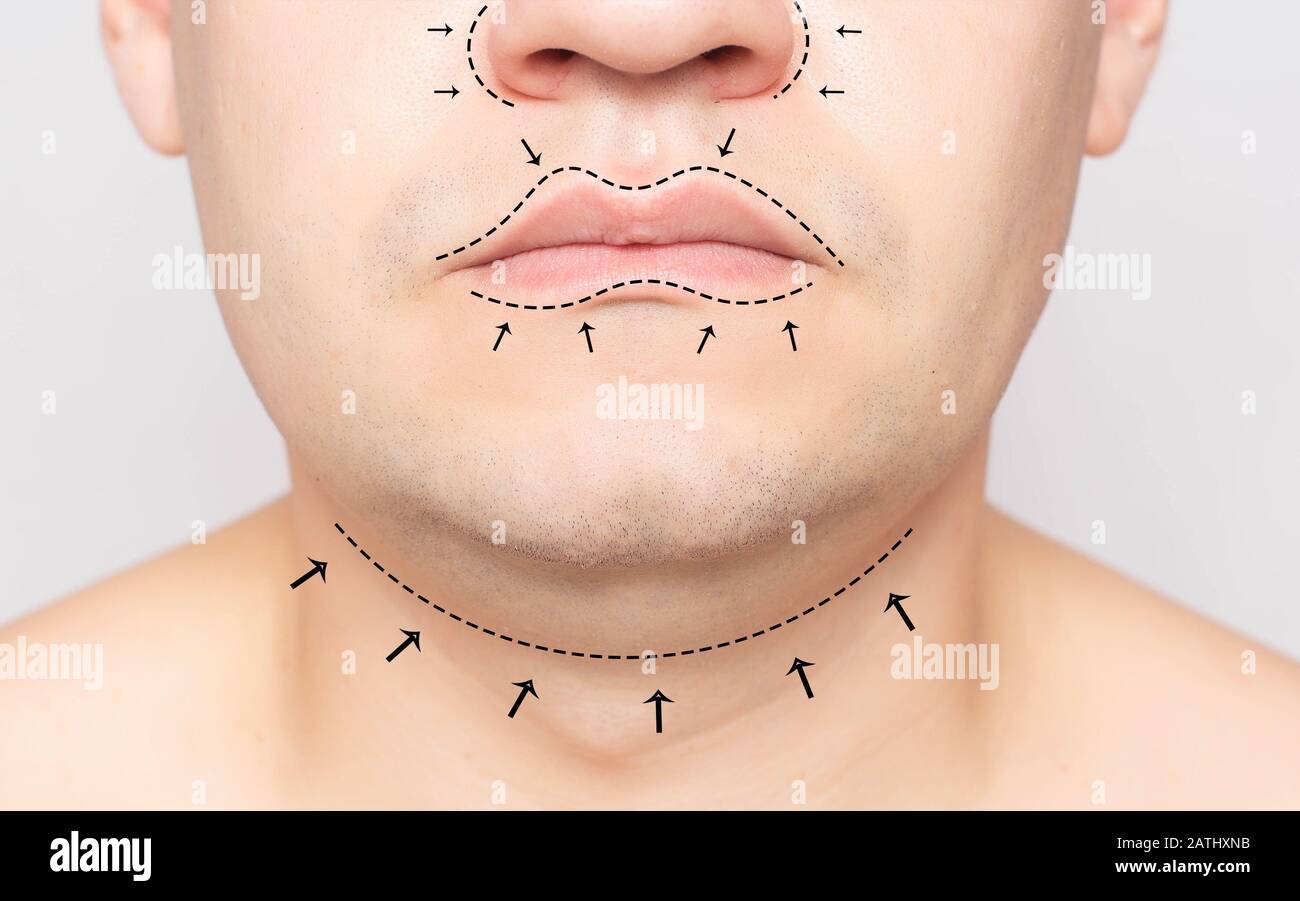 The face of a man marked with a marker before plastic surgery. Concept of facelift, rhinoplasty, double chin removal in plastic surgery, clinic Stock Photo