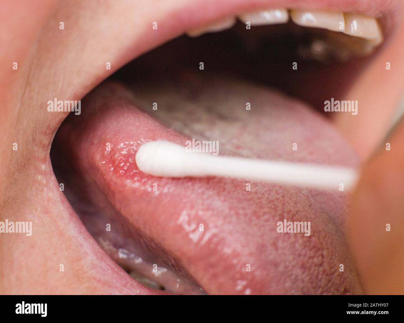 wallpapers Tongue Diseases Pictures https www alamy com taking a smear for a disease in the tongue of a woman glossitis and gingivitis tongue disease research concept image342143095 html