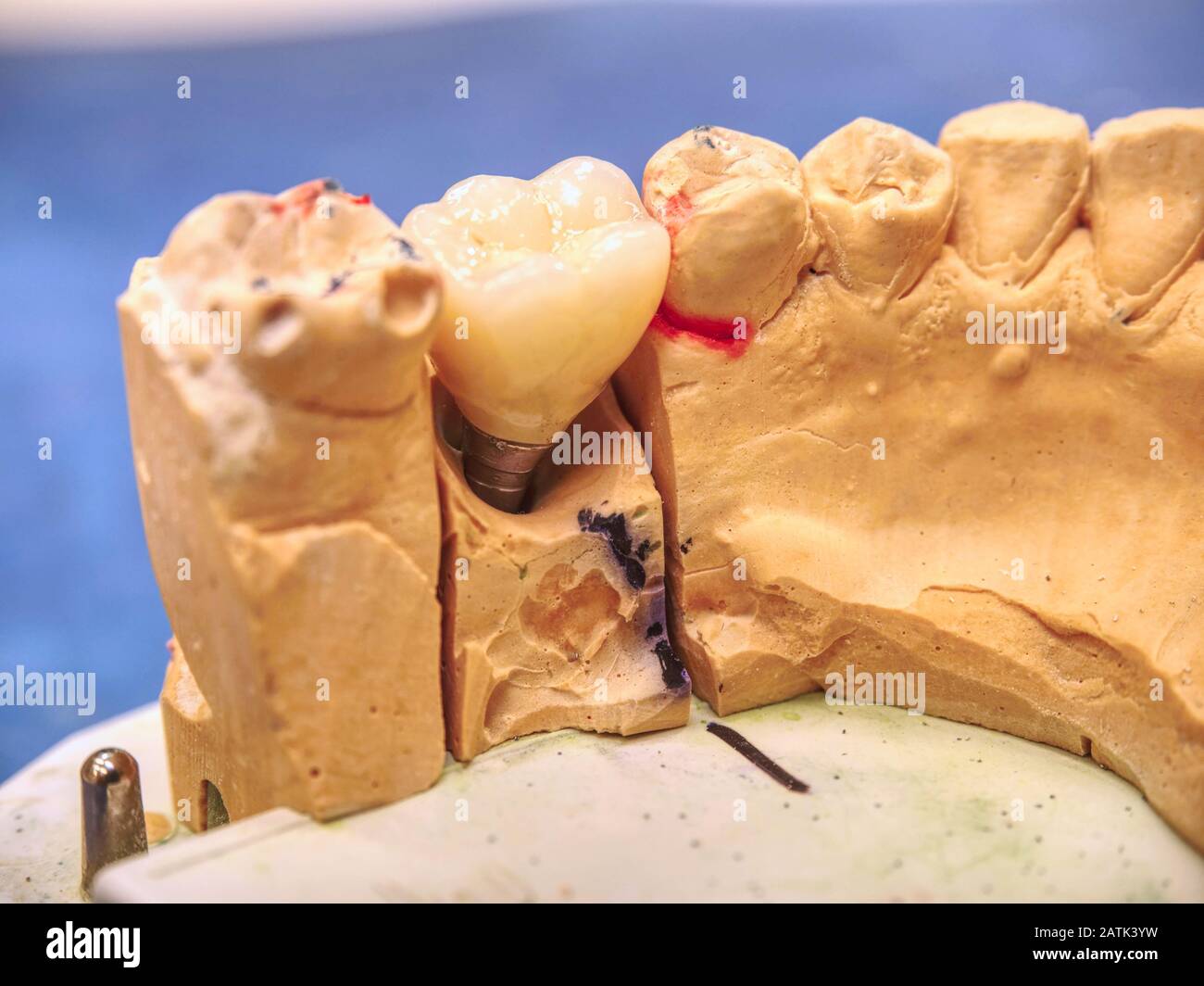 Ceramic and zirconium crowns of human tooth on a gypsum model in dental