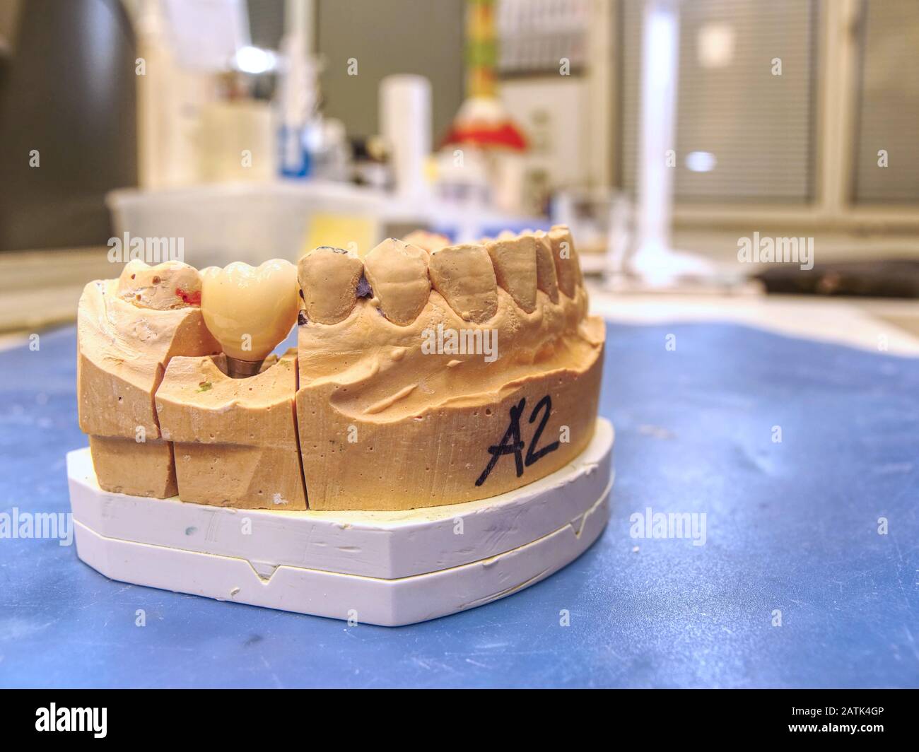 Dental prosthesis in semiprocess. Test of artificial tooth prosthetic, handmade modern dental ceramics implantat. The denture, false teeth. Stock Photo