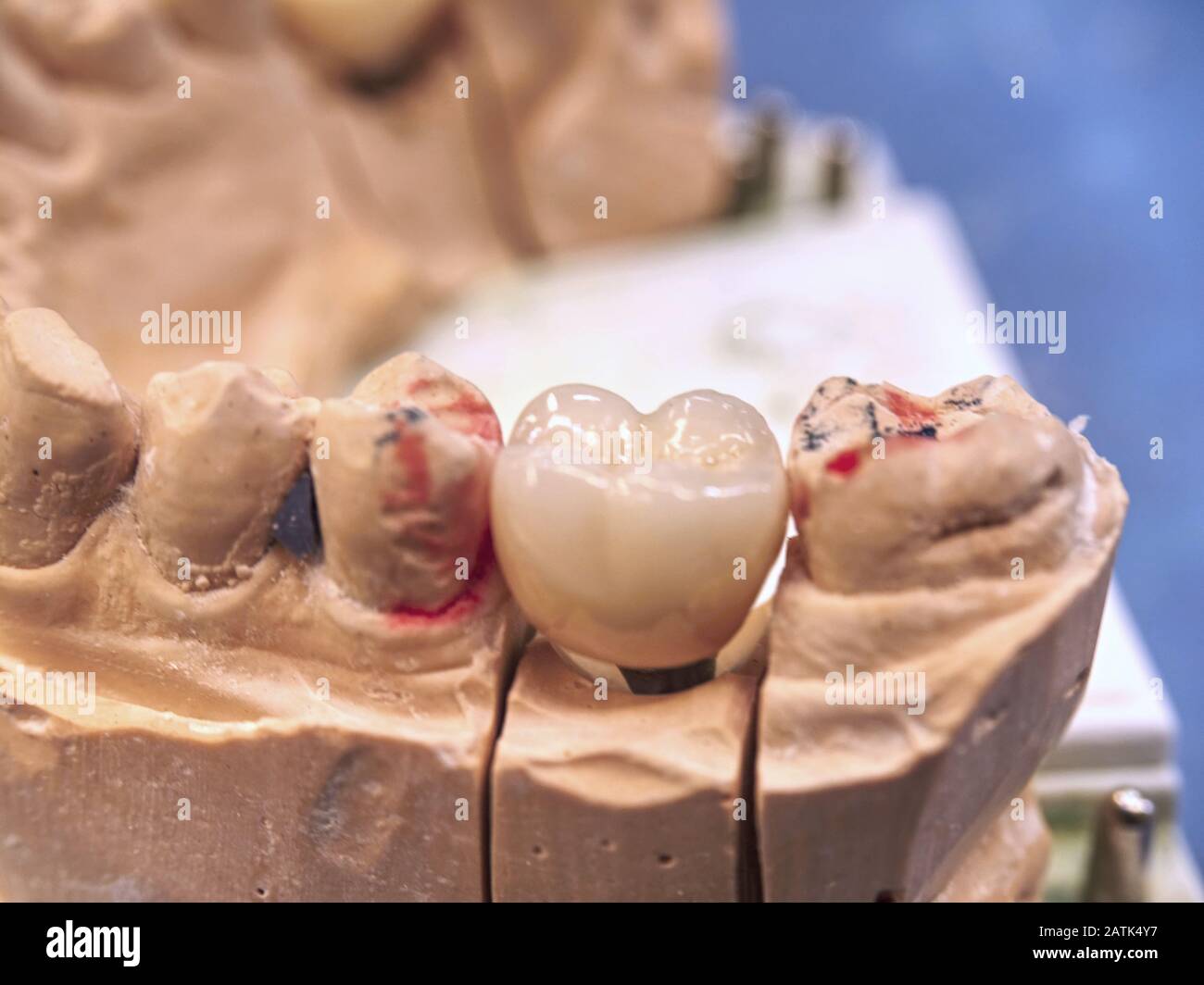 Dental implant model with pin and dental implant. Dental casting gypsum