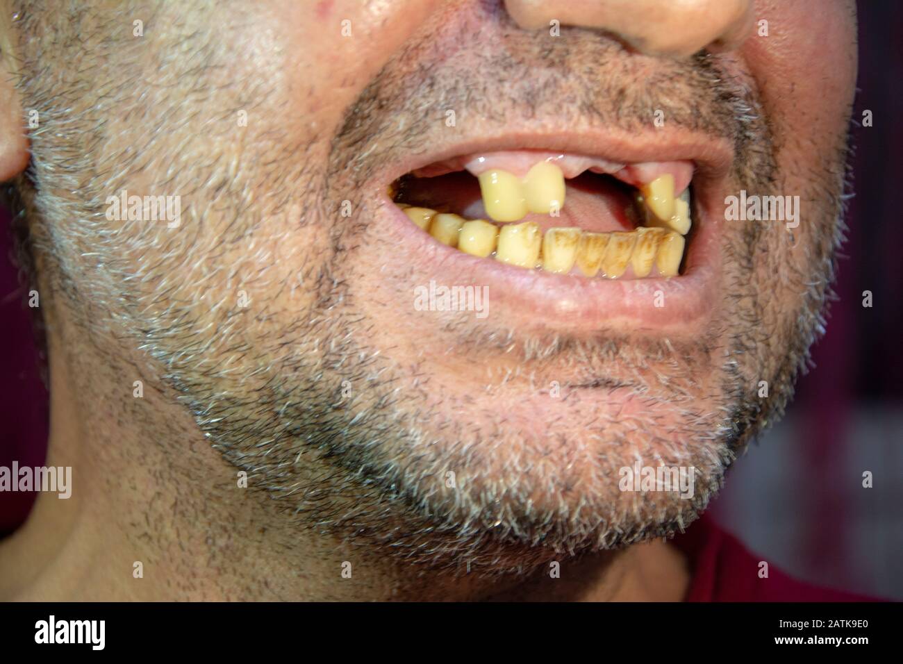 Toothles Man Stock Photo