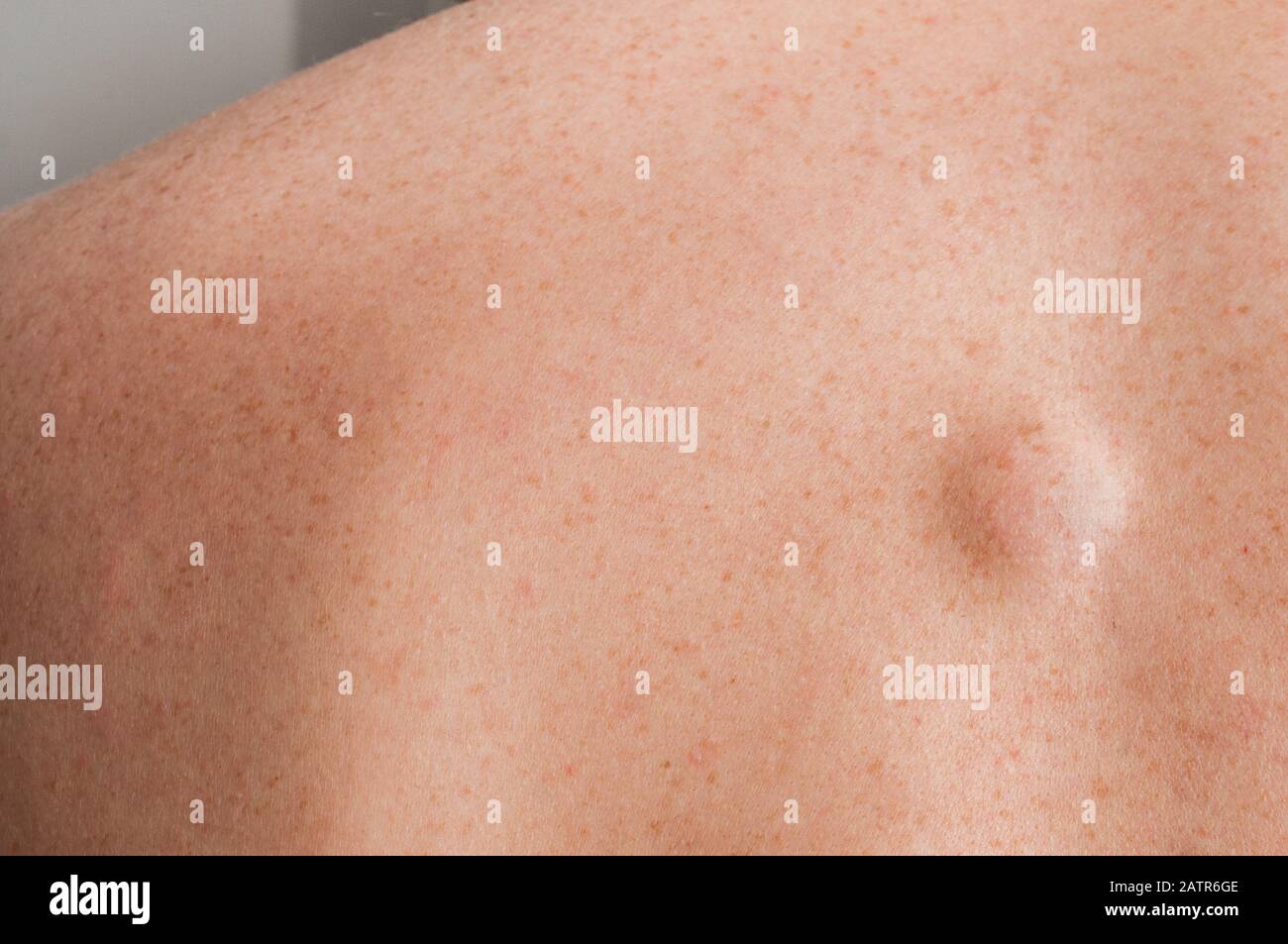 Lipoma Cross Section