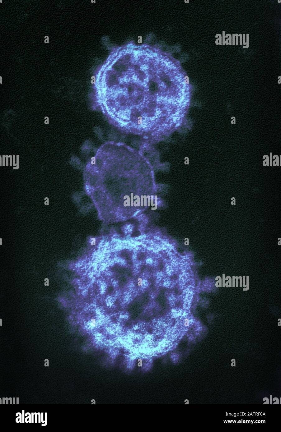 Highly magnified, digitally colorized transmission electron microscopic (TEM) image showing ultrastructural details exhibited by three, spherical shaped, Middle East respiratory syndrome coronavirus (MERS-CoV) virions, 2014. MERs is in the same family as the novel coronavirus which began to infect patients in Wuhan, China in early 2020. Courtesy National Institute of Allergy and Infectious Diseases (NIAID)/CDC. Image produced in 2014. () Stock Photo