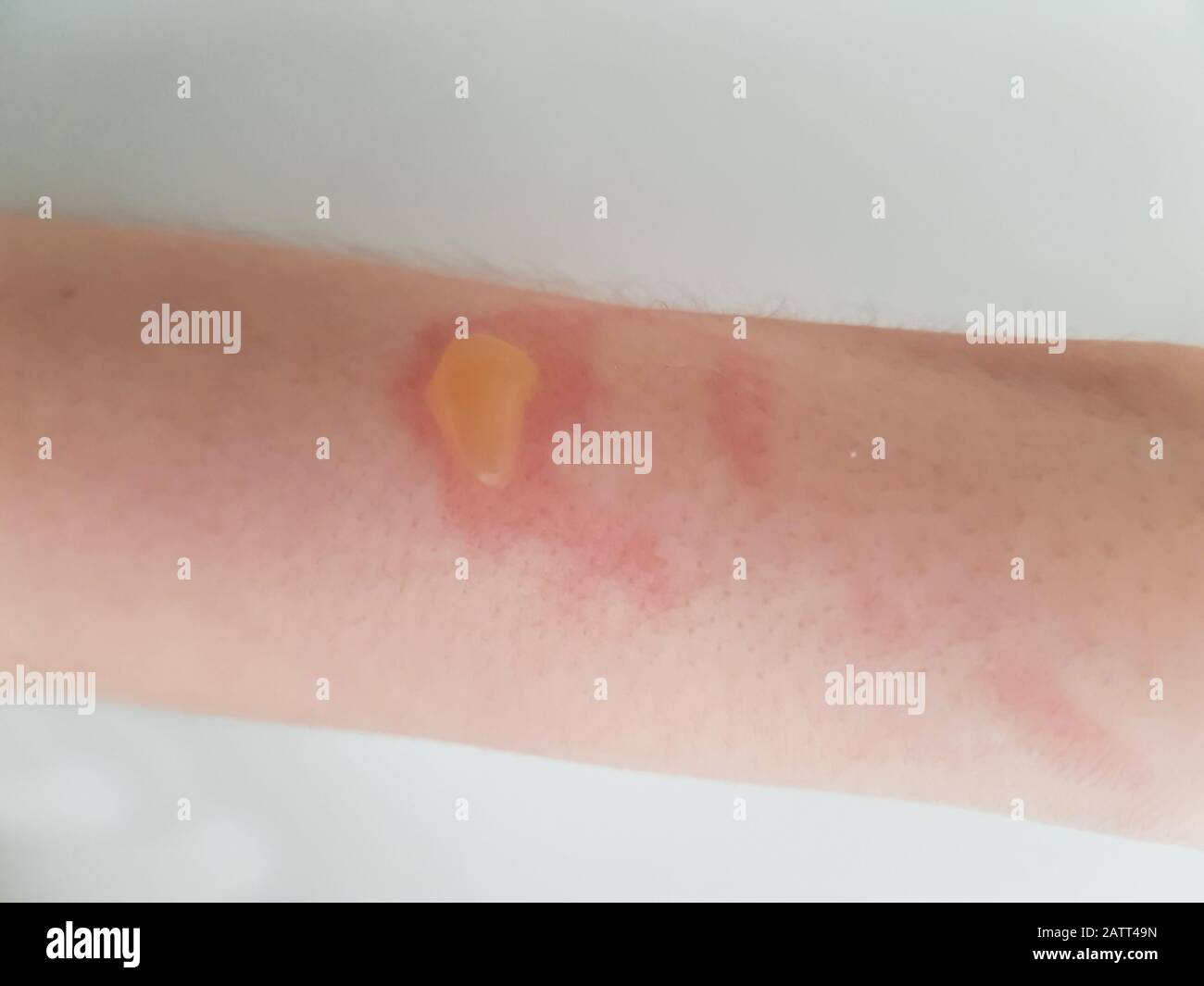 burn healing burn healing