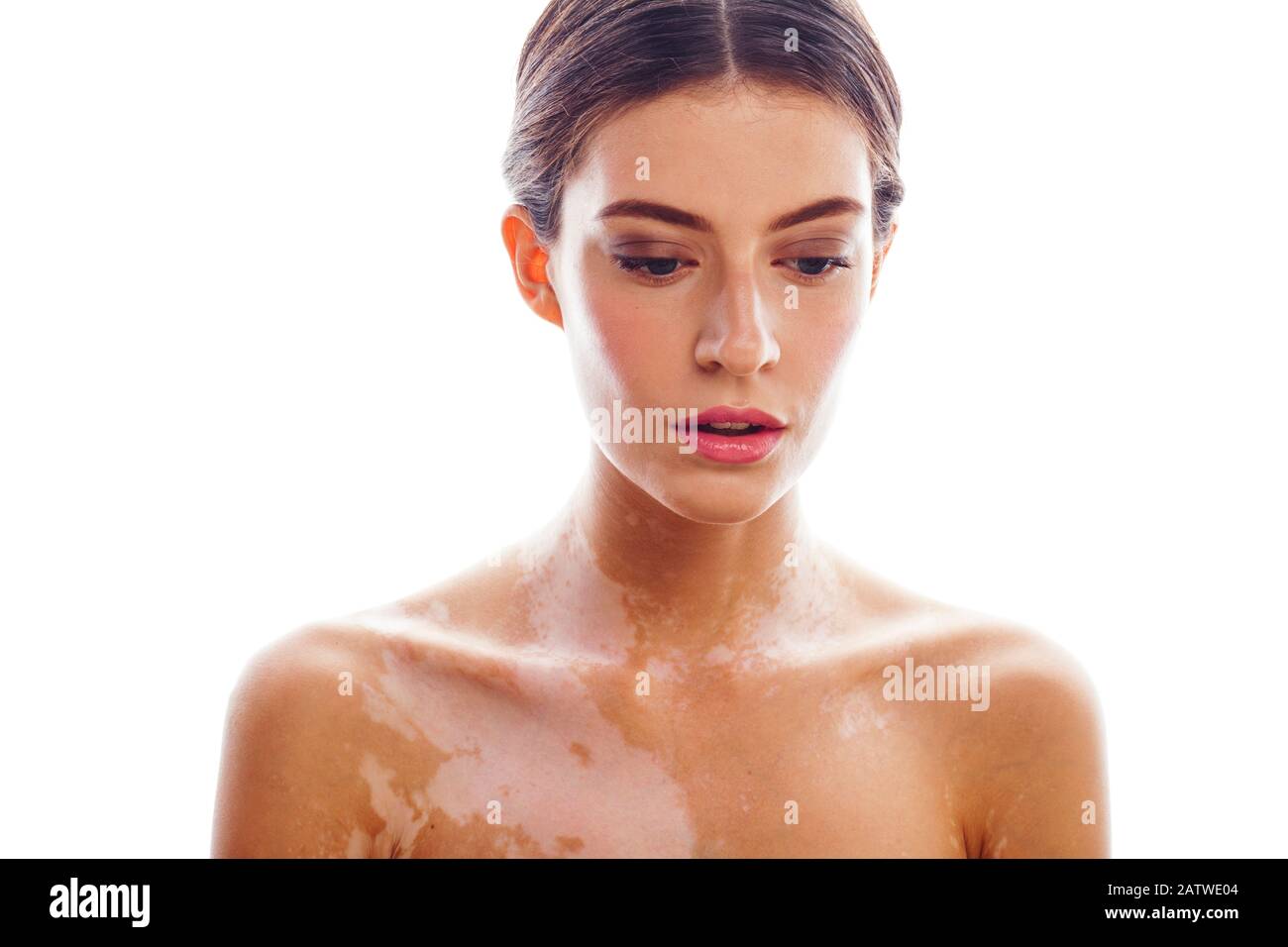 beautiful young woman with vitiligo disease isolated on white positive smiling, model
