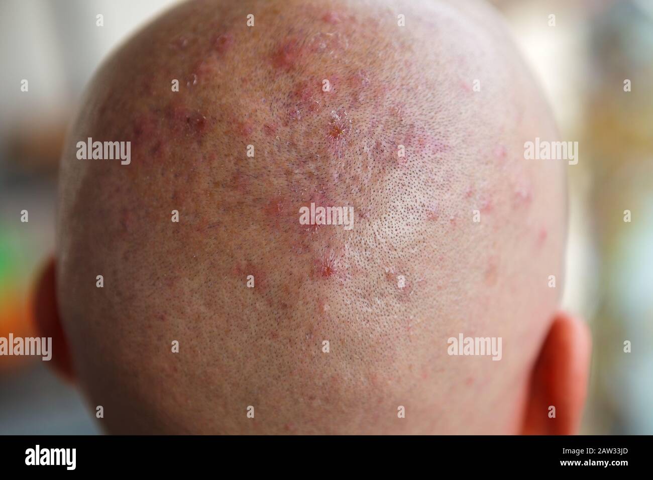 Man's shaved head with diseased skin, acne and eczema Stock Photo