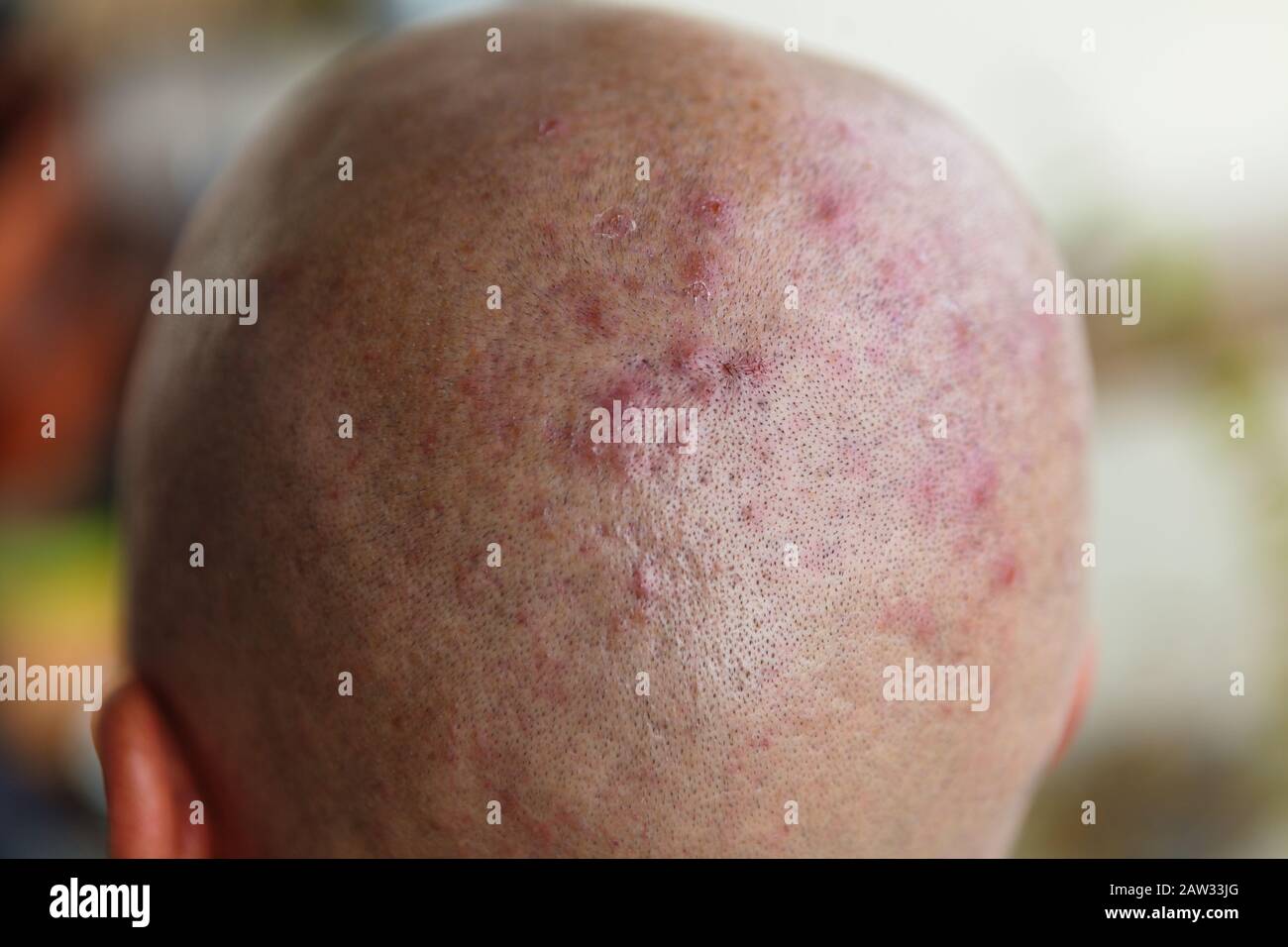 Man's shaved head with diseased skin, acne and eczema Stock Photo