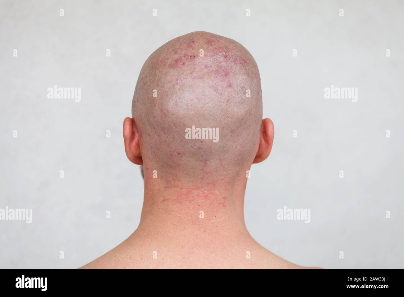 Man's shaved head with diseased skin, acne and eczema Stock Photo