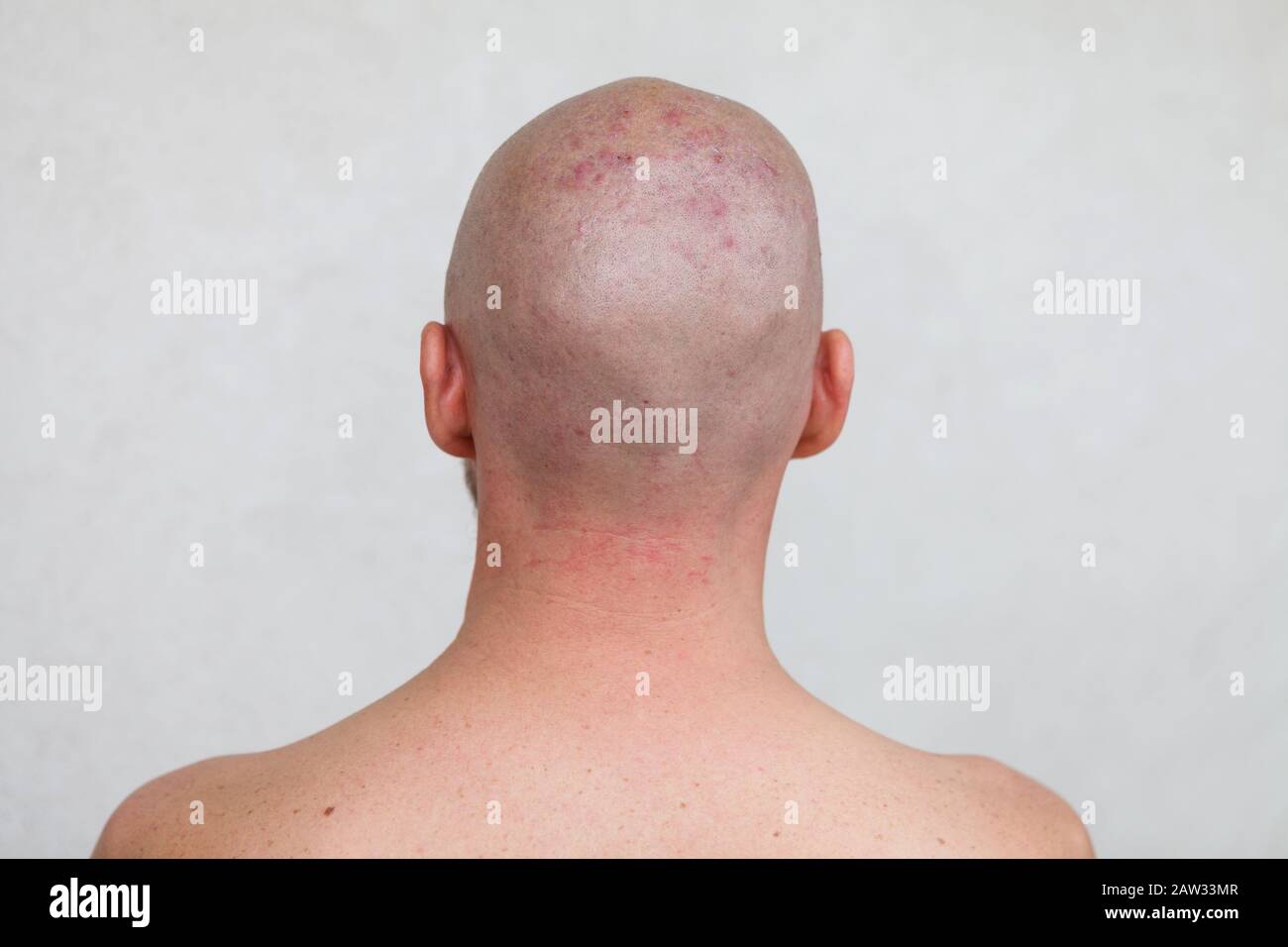 Man S Shaved Head With Diseased Skin Acne And Eczema Stock Photo Alamy Man S Shaved Head With Diseased Skin Acne And Eczema Stock Photo Alamy