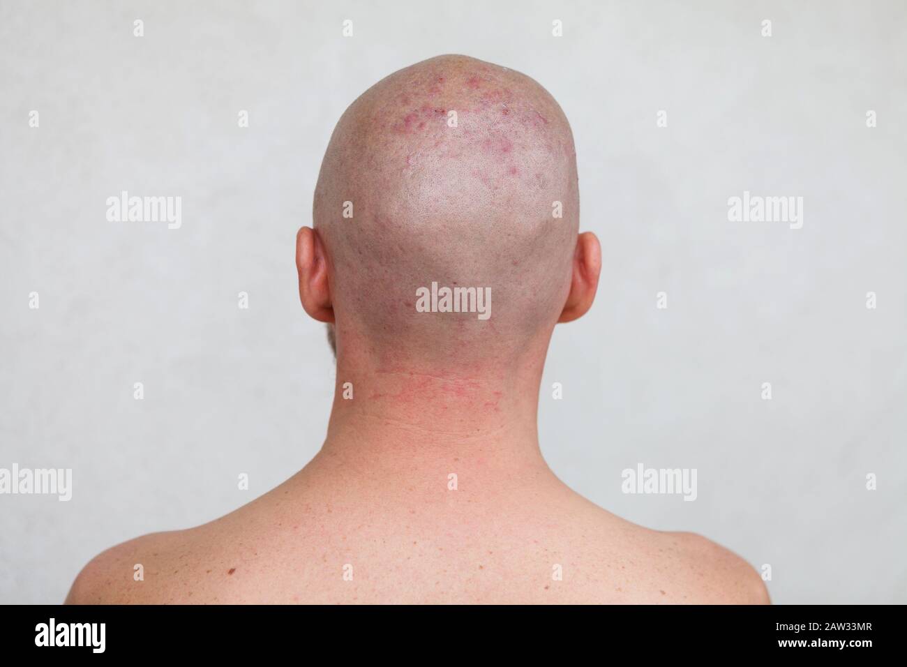 Man's shaved head with diseased skin, acne and eczema Stock Photo