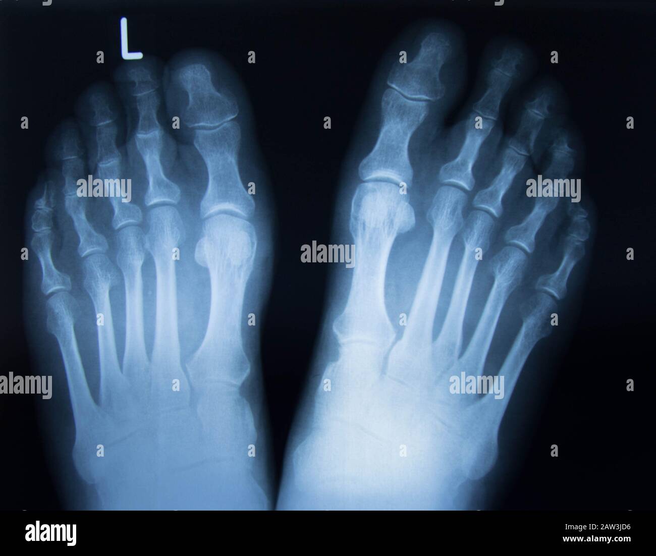 normal radiography of the foot, medical diagnostics, Traumatology and orthopedics, rheumatology Stock Photo