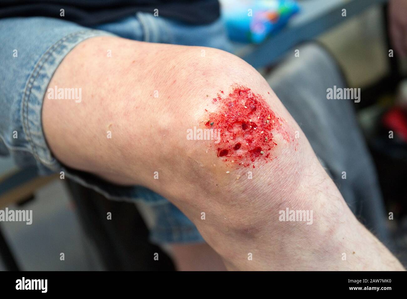 Waiting for first aid. Due to a fall, stones have fallen in the knee and bleed Stock Photo
