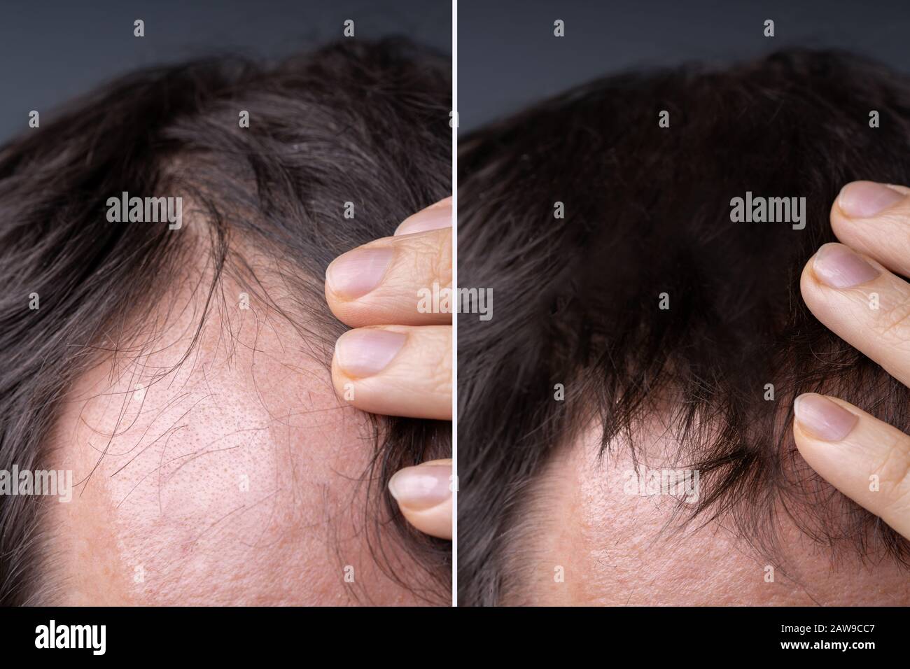 Man Before And After Successful Hair Loss Treatment Stock Photo