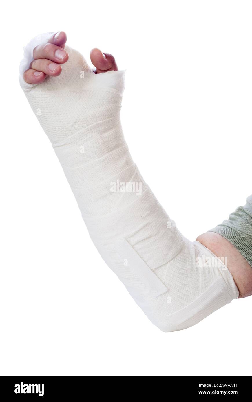 Side view of a man with a broken arm in a splint and cast. His fingers are discolored and swollen. Isolated on white background. Stock Photo