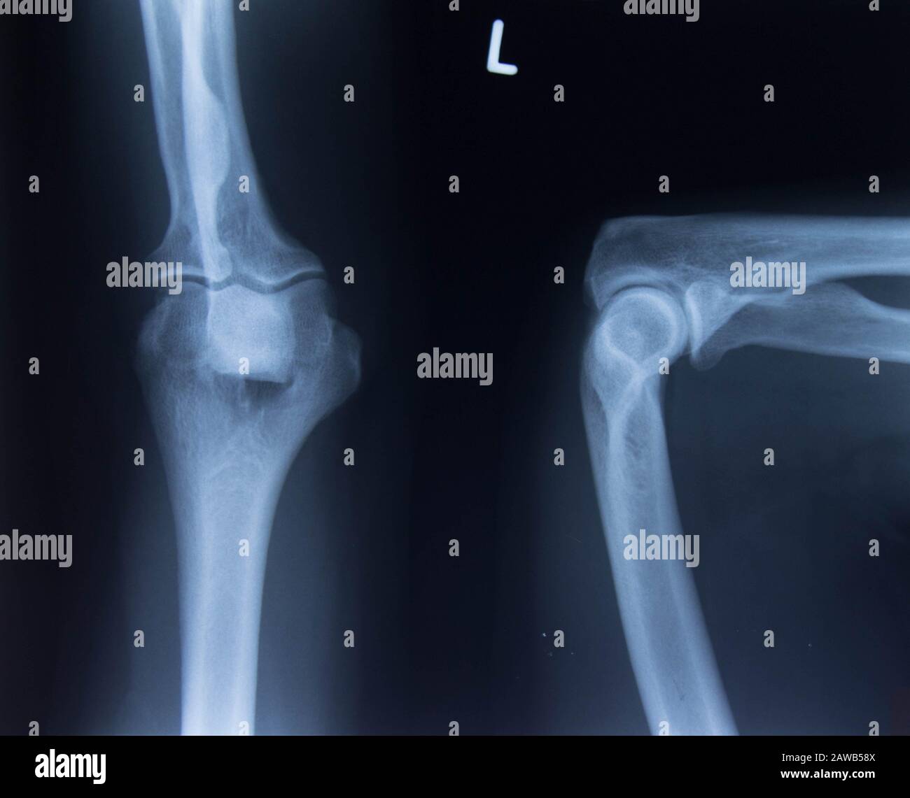 X-ray of the knee joints. Deforming arthrosis Stock Photo