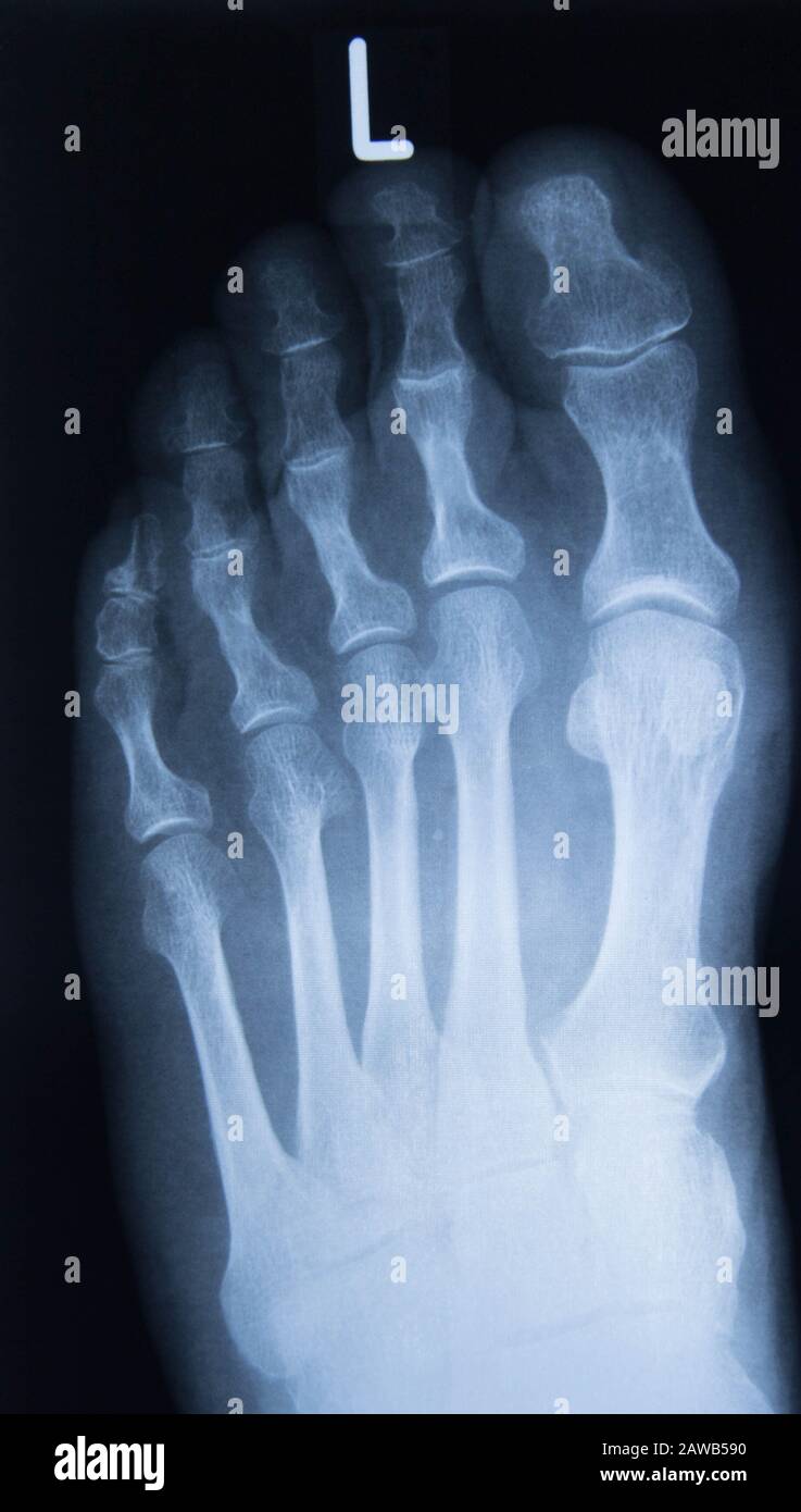 normal radiography of the foot, medical diagnostics, Traumatology and orthopedics, rheumatology Stock Photo