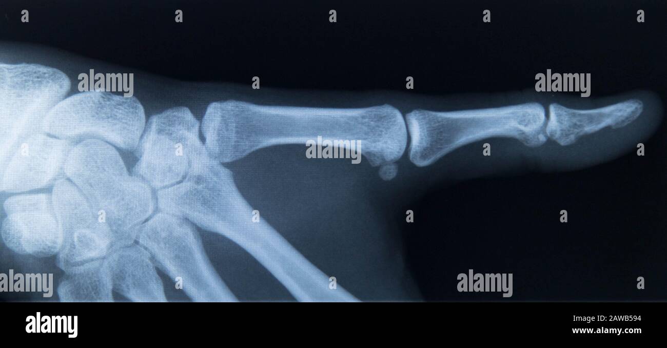 xray index finger Stock Photo Alamy