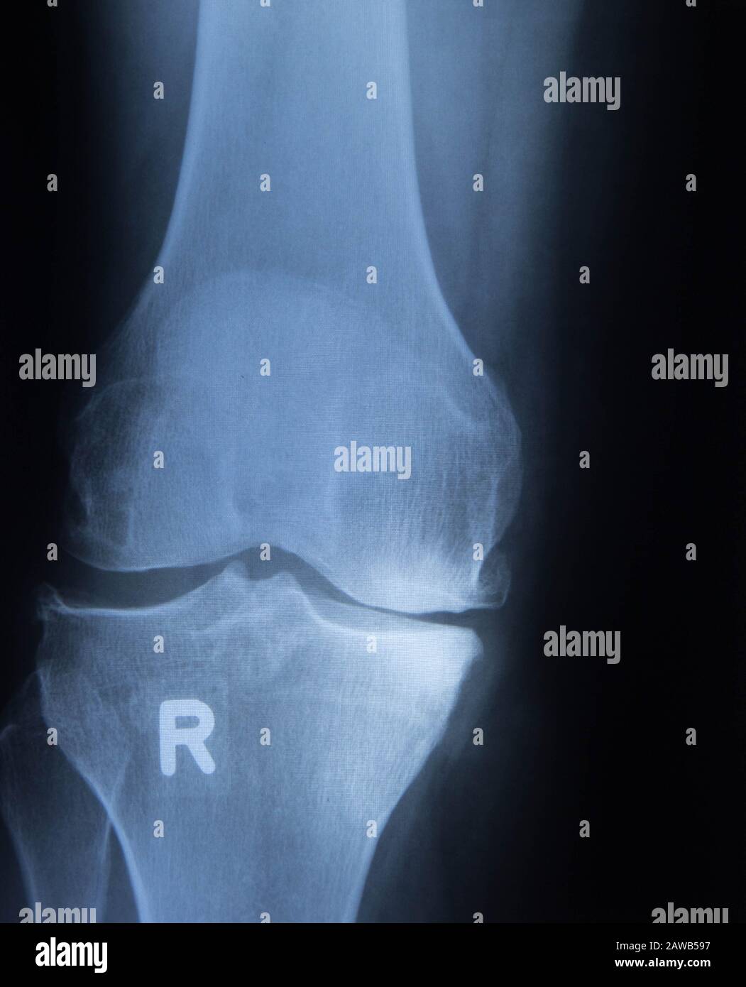 X-ray of the knee joints. Deforming arthrosis Stock Photo