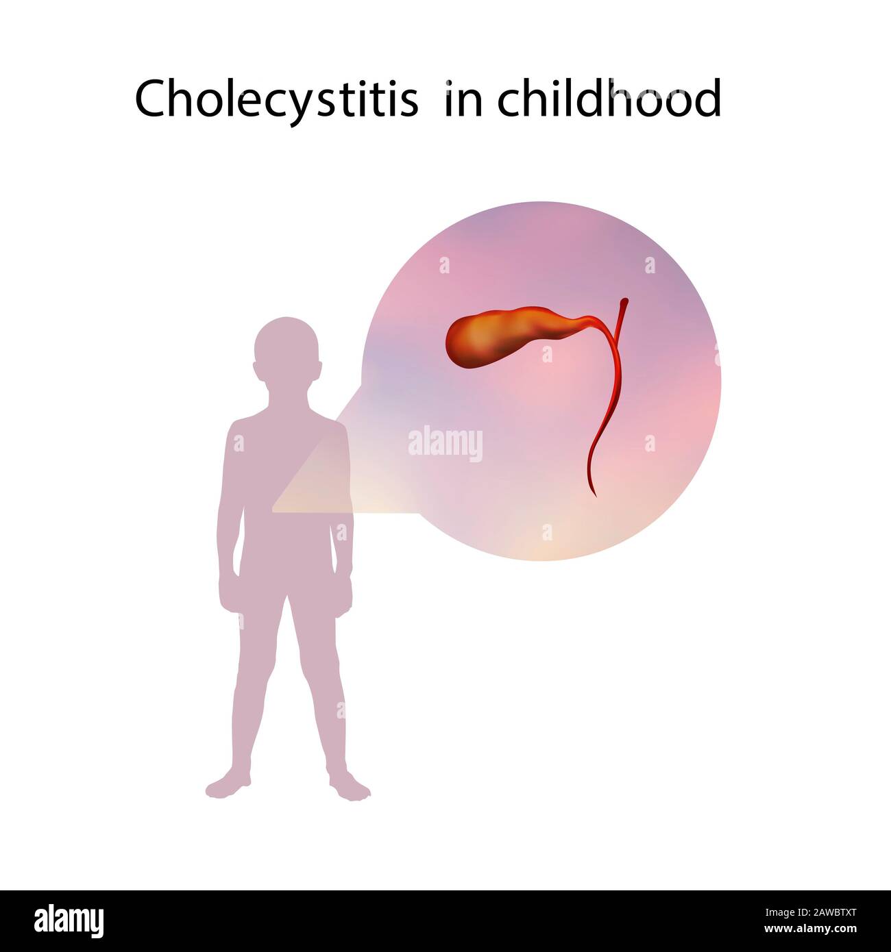 Cholecystitis in childhood, illustration Stock Photo