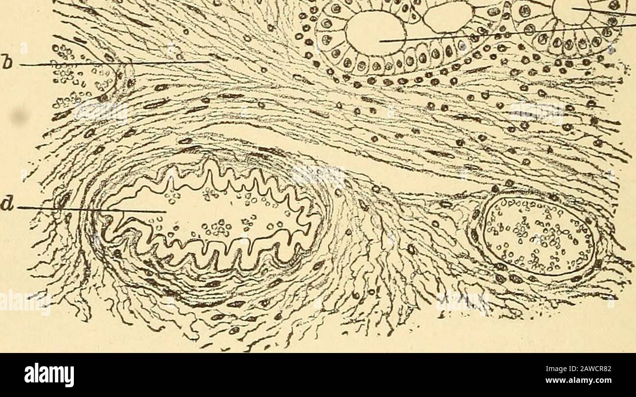 A text-book on diseases of the ear, nose and throat . k^.. Section of entire thickness of mucous membrane in atrophic rhinitis. (Stoerk.) a, pavementepithelium; b, b, connective tissue moderately rich in cells ; c, c, glands largely degenerated; d, blood-vessel with excessively enlarged Avail. fresh secretion obtained just after cleansing contained but few micro-organisms and had no fetor, but that removed after six hours was putridand loaded with bacteria. Abel, Paulsen, and other observers foundamong these a bacillus constantly present on the mucous surface, whichis called the bacillus capsu Stock Photo