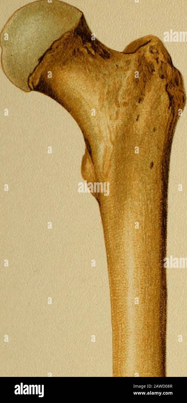 Macerated wound hires stock photography and images Alamy