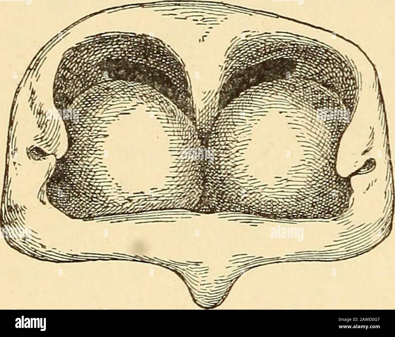 A text-book on diseases of the ear, nose and throat . disease, as the wire loop will usually slip off instead ofseizing the protuberant mucous membrane. If this be retracted bycocaine, it is quite impossible to use the wire loop. D. Braden Kylemakes linear incisions instead of cauterizations, and reports better resultsthan from the galvano-cautery. CHAPTEE IX. HYPERTEOPHIC AND ATROPHIC RHINITIS,HYPERTROPHIC RHINITIS. In hypertrophic rhinitis the chronic congestion of the nasal mucousmembrane has led to a true connective-tissue hyperplasia, localized chieflyon the inferior and middle turbinals Stock Photo