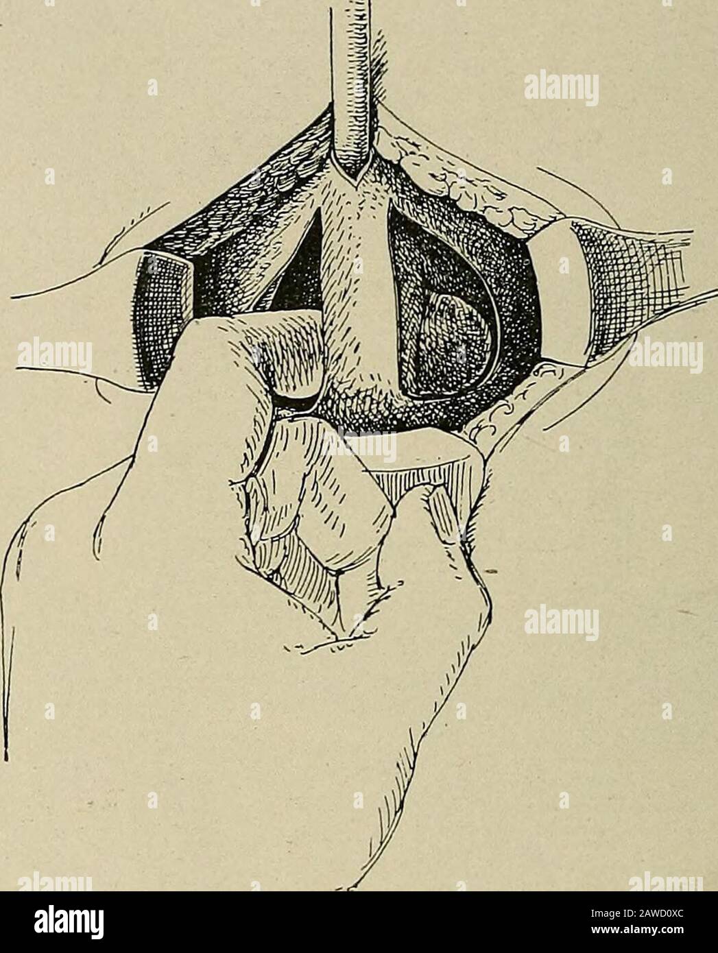 Operative surgery, for students and practitioners . Fig. 316.—Perineal Prostatectomy (Young). Membranous urethra opened justanterior to prostate and tractor introduced. Incision through the sheath ofprostate. Detaching the sheath from the right lobe with the blunt dissector. 702 URINARY SYSTEM. injur)^ The incisions, being 1 cm. deep, reach into the substance ofthe prostate beyond the level of the ducts and close to the sides of theurethral canal. The fibrous sheath is separated from the prostate with the bluntdissector. It is important to start in the correct line of cleavage.As this step of Stock Photo