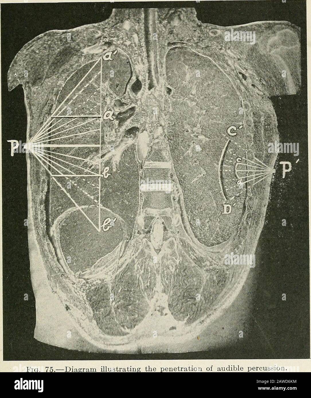 Diseases of the chest and the principles of physical diagnosis . ed was to the eflfect that percussion -v-ibrations penetrated only 5to 7 cm., thus only -t to 5 cm. into the lung itseK. This beUef was founded on the factthat liver dulness could not be demonstrated when more than 4 to 5 cm. of lung tissueoverlay it. The following experiments show that even light percussion has a deeppenetration. I. Moritz and Rihl beat up into a spongy froth, a solution of stiflfening gelatin towhich formalin and carbohc acid had been added, this closeh* resembling lung tissue in METHODS AND RESULTS OF PERCUSSI Stock Photo