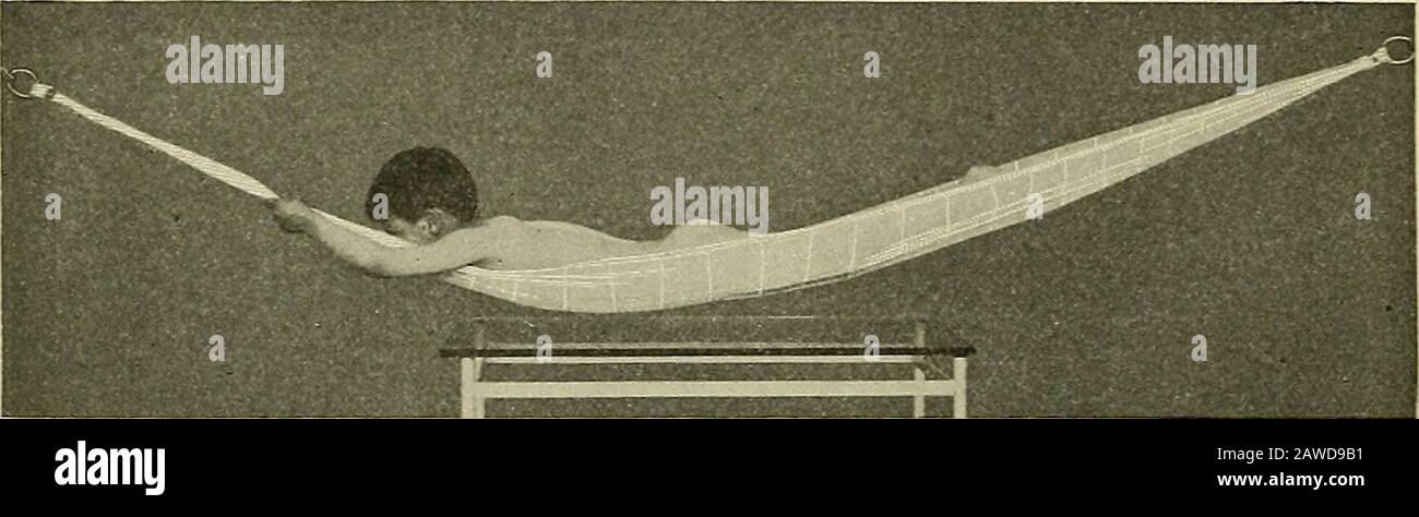 Postoperative bracing. Immediately after surgery, the patient is placed