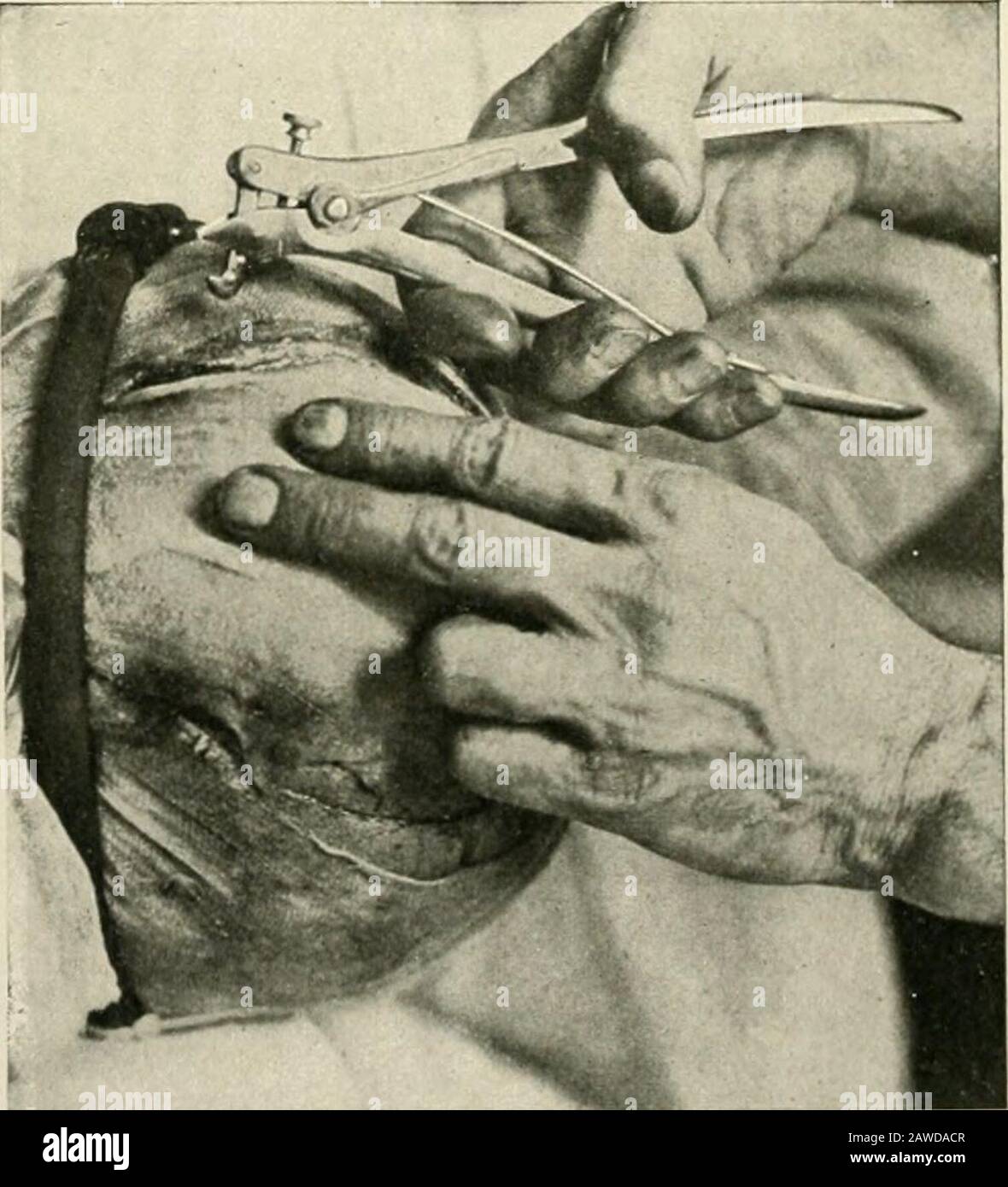 The practice of surgery . Fig. 426.—Opening the skull—step 1 ((usliing in Keens Surgely).. Fig. 427.—Opening the skull—step 2. Dahlgren forceps used for incision oflateral edges of Ijone-flap Avhen approaching thinner jiortion of cranium in temj)oralregion (Gushing in Keens Surgerj-)- The patients head should be shaved completely and this should bedone deftly and gently, preferably on the operating table. Then theanesthetic should be given, and for this I use ether. With the patient INTRACRANIAL OPERATIONS 665 unconscious, cleanse the skin, and over the whole head throw a wetbichlorid compress Stock Photo