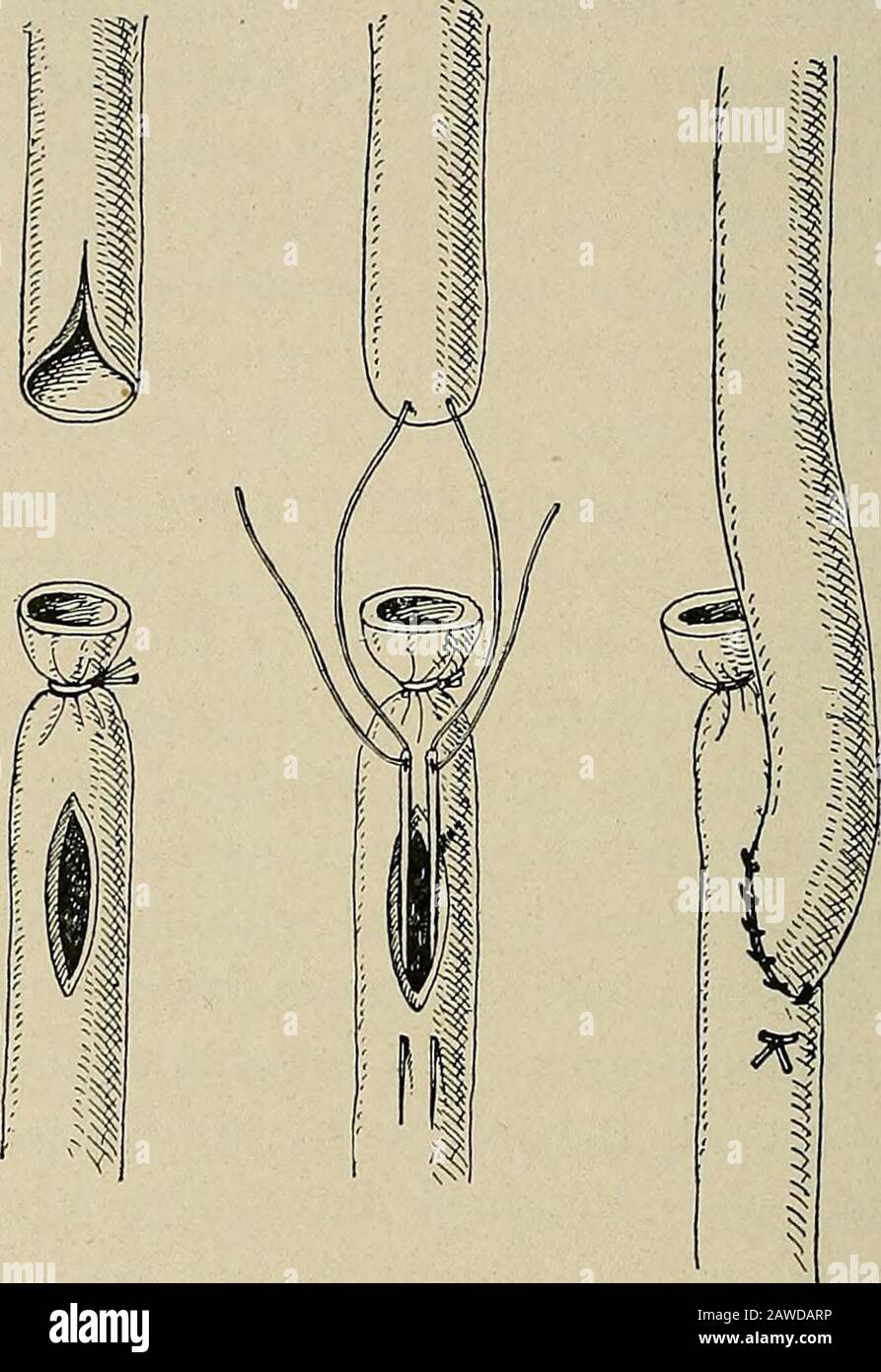 Operative surgery, for students and practitioners . omic catgut. The  incision in the peritoneal layerthat covers the ureter is also sutured. A cigarette  drain is left inthe abdomen reaching down to the