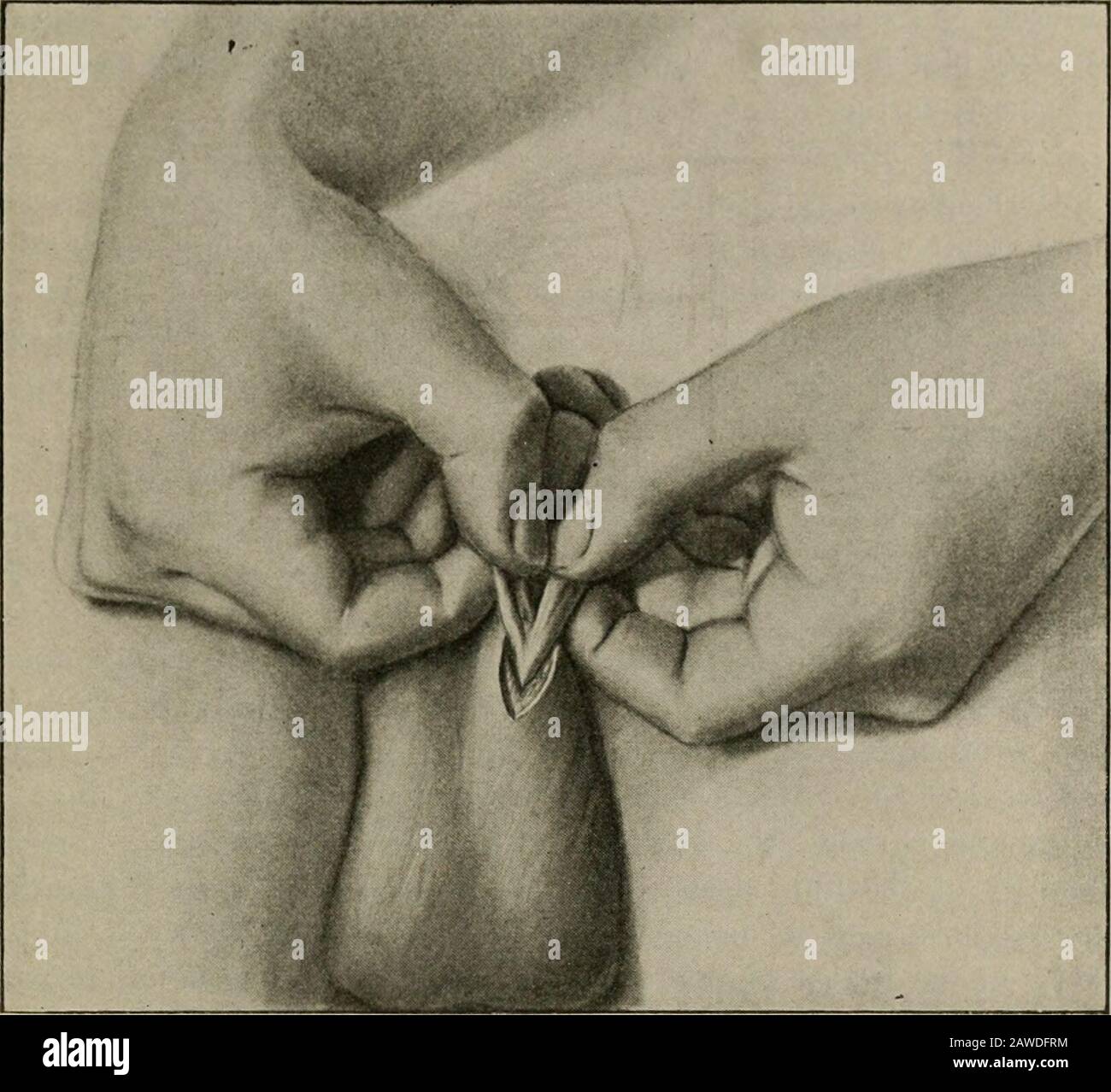 Operative surgery, for students and practitioners . s (A) have beenseparated from the other structures of the cord—from the spermatic artery andpampiniform plexus (B). Ligatures have been tied about B above and belowpreparatory to excising the intervening portion. rated from the vas deferens, etc., are tied, one above and the otherbelow. The portion intervening is excised with the scissors, not tooclose to the ligatures, and the ends of the ligatures, which have beenpurposely left long, are then tied together, in this way bringing theends of both stumps into apposition. The ends of these two p Stock Photo