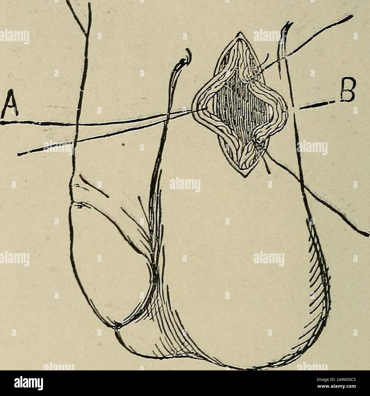 Operative surgery, for students and practitioners . ^forceps and then cut so that we have two ligatures. These ligatures,which surround all those structures of the cord that have been sepa-. Fig. 291.—Varicocele. The vas deferens and adjoining vessels (A) have beenseparated from the other structures of the cord—from the spermatic artery andpampiniform plexus (B). Ligatures have been tied about B above and belowpreparatory to excising the intervening portion. rated from the vas deferens, etc., are tied, one above and the otherbelow. The portion intervening is excised with the scissors, not tooc Stock Photo