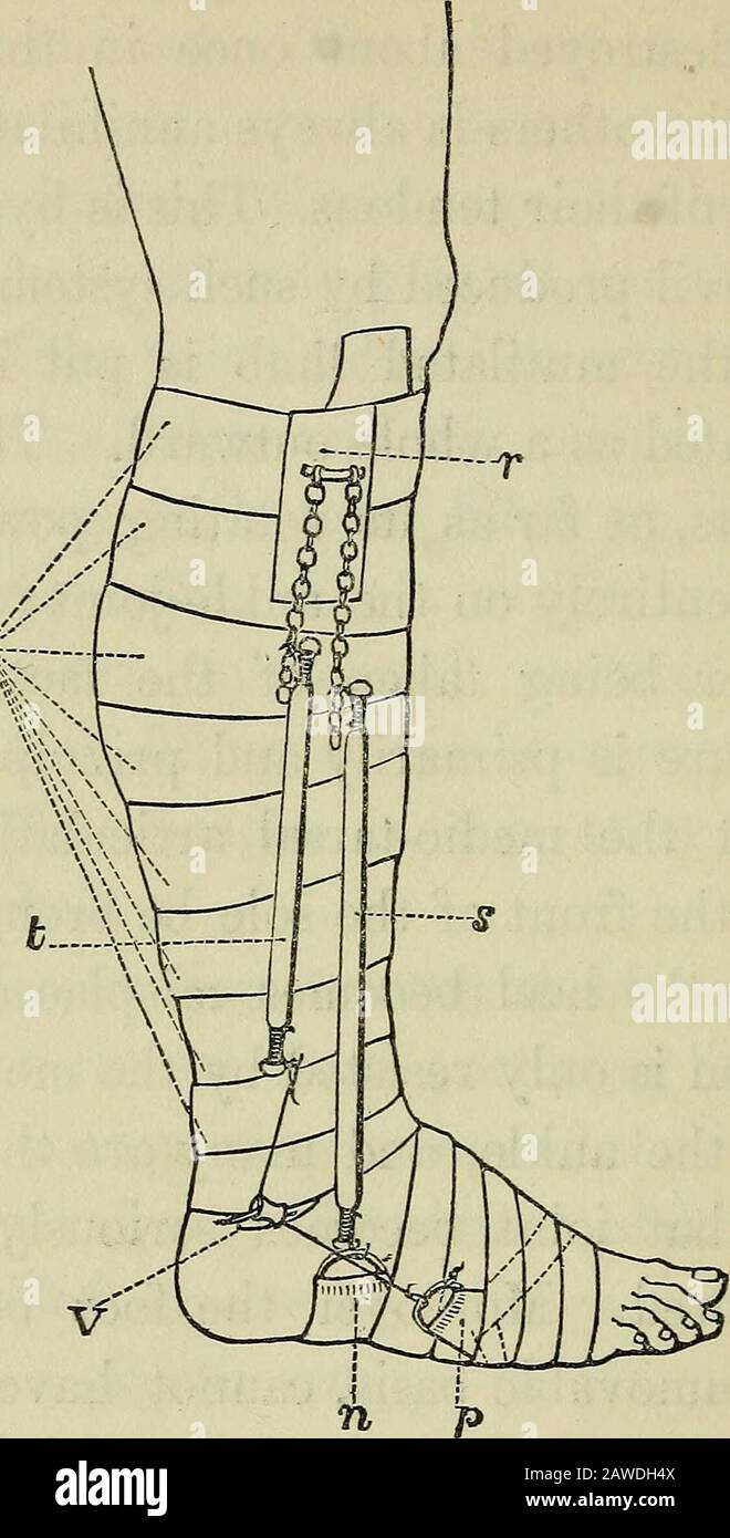 On the cure of club-foot without cutting tendons : and on certain