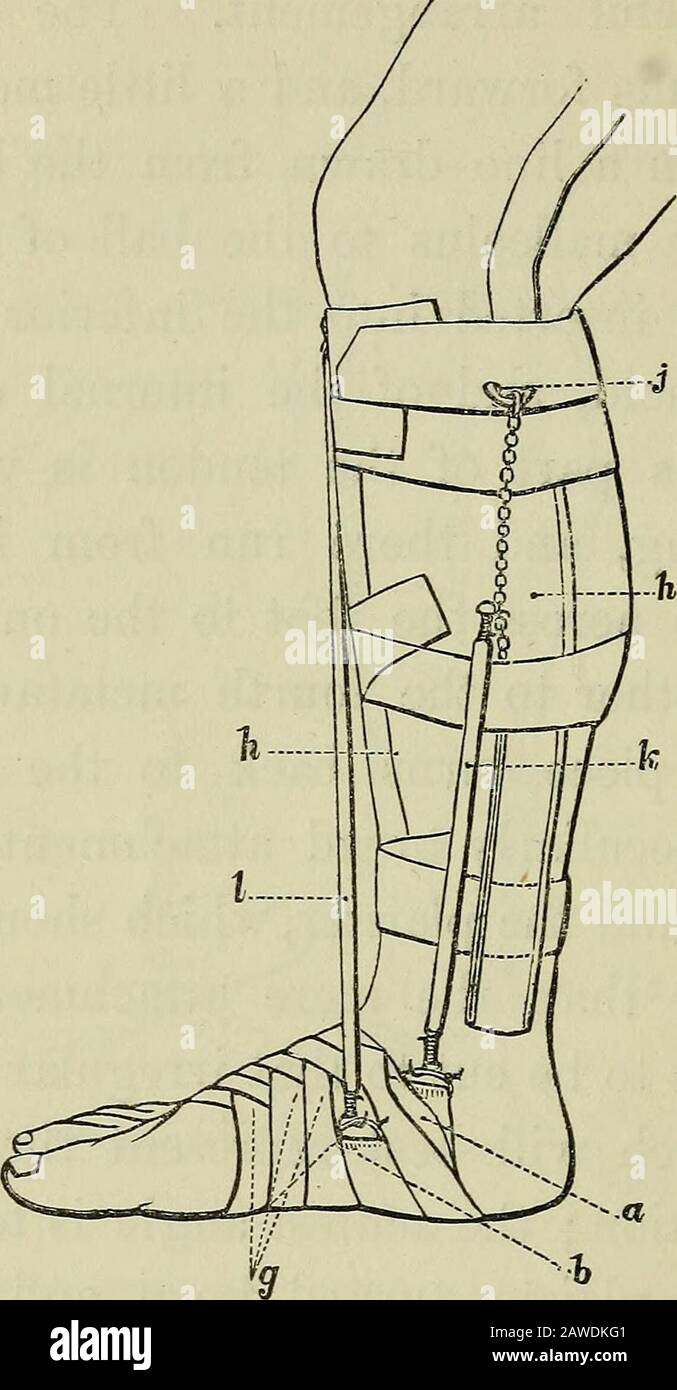 On the cure of club-foot without cutting tendons : and on certain