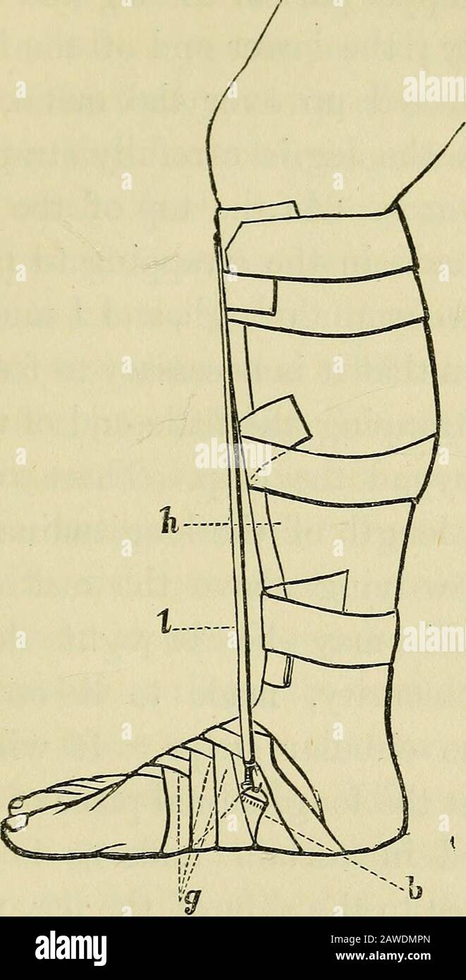 On the cure of club-foot without cutting tendons : and on certain