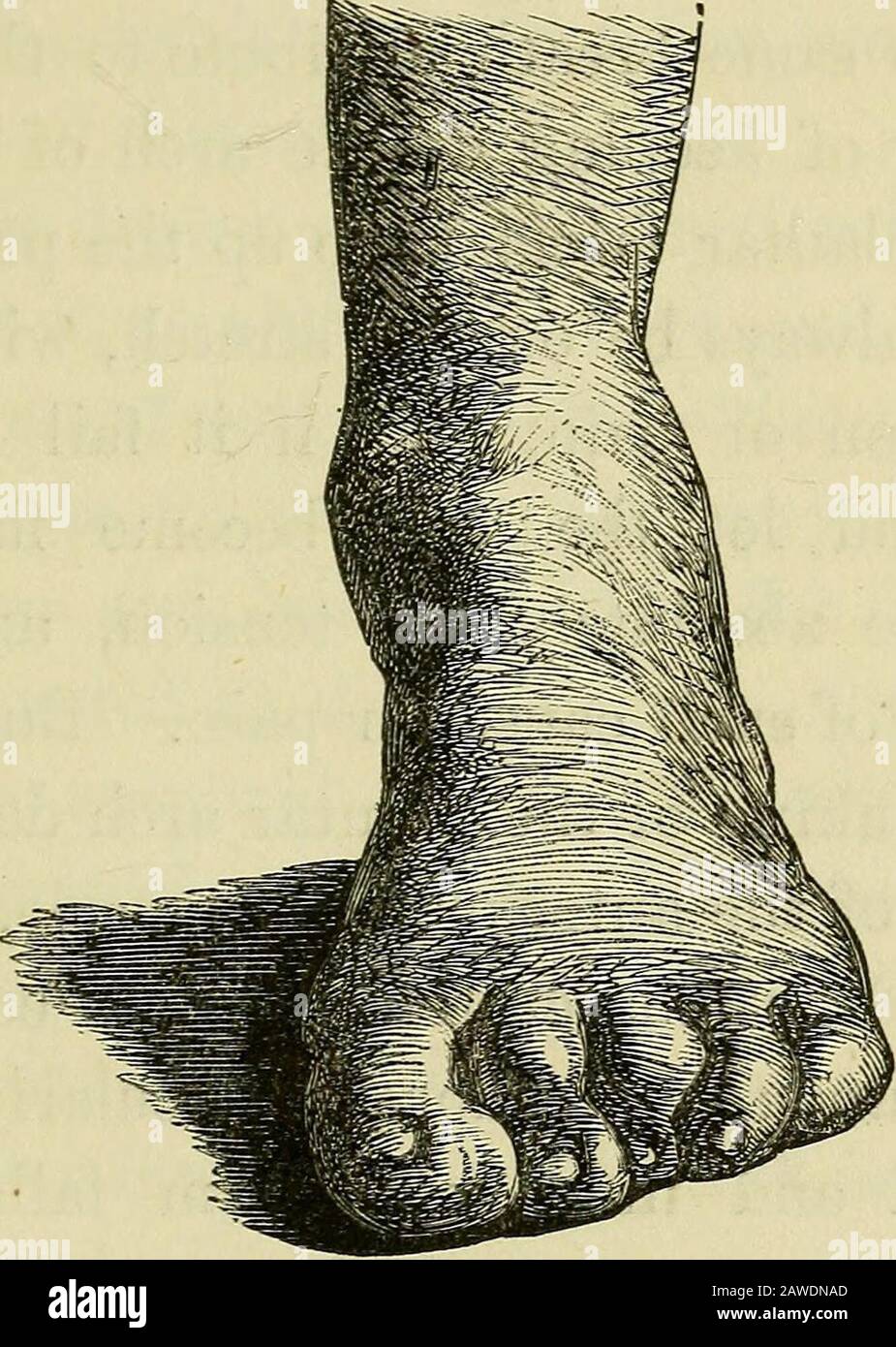 On the cure of club-foot without cutting tendons : and on certain