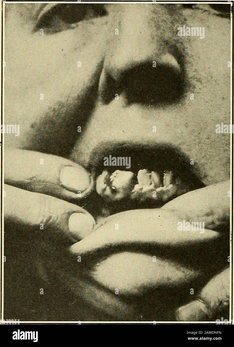 Cauterization of papilloma hires stock photography and images Alamy