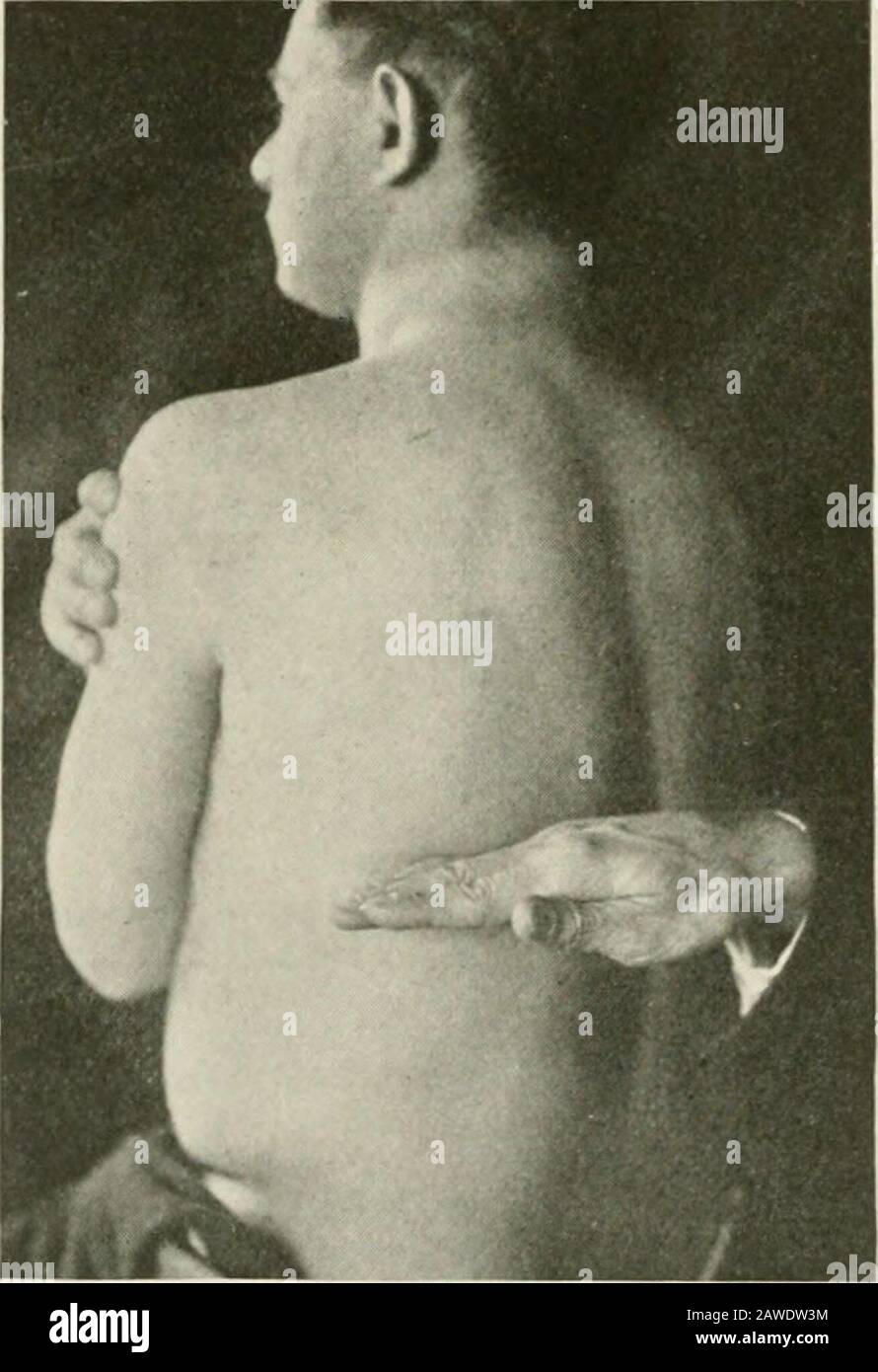 Diseases of the chest and the principles of physical diagnosis . tral diaphragmatic pleura is supi)lied by the phrenic nerve. Irrita-tion of this region produces pain and tenderness in the neck, especiallyalong the ridge of the trapezius muscle, often with a surrounding zoneof hyperesthesia (Fig. 41). This is a true referred pain—by way of thethird and fourth spinal segments. The pericardial pleura when irritatedmay produce similar pain, because its nerve supply is mainly if not en-tirely phrenic in origin (Capps). Pleural pain may be referred to the abdominal wall and lack of acareful examina Stock Photo