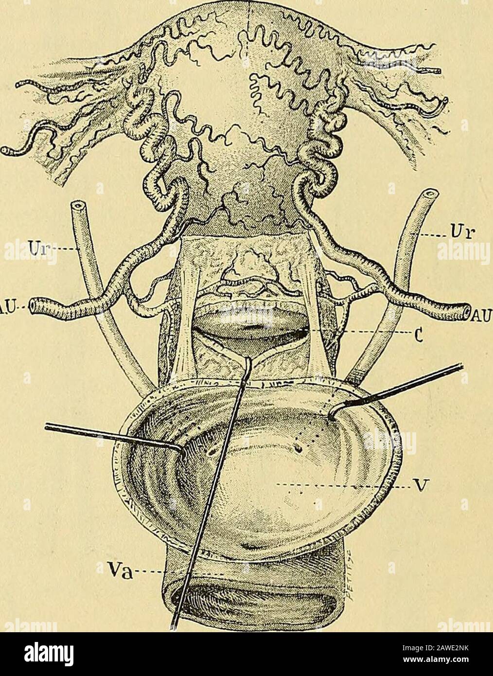 Traité de gynécologie clinique et opératoire . Constance, qui fit la première extirpation vaginale dutérus cancéreux non prolabéen 1822, et eut un succès opératoire, et Récamier qui en 1829, réussit dans sa première opé-ration. Les revers se multiplièrent ensuite et firent abandonner lopération, qui ne pou-vait renaître que dans lère de la chirurgie antiseptique. Consulter sur les débuts de cette renaissance : Freund. Zur Totalexstirpation desUtérus (Zeitschr. f.Geb. und Gynàk., VI, 2). — Czerny. Ueber Ausrottung des Gebârmul-terkrebs {Wiener med. Wochensch., 1879, n03 45, 49). —Démons.(Archiv Stock Photo