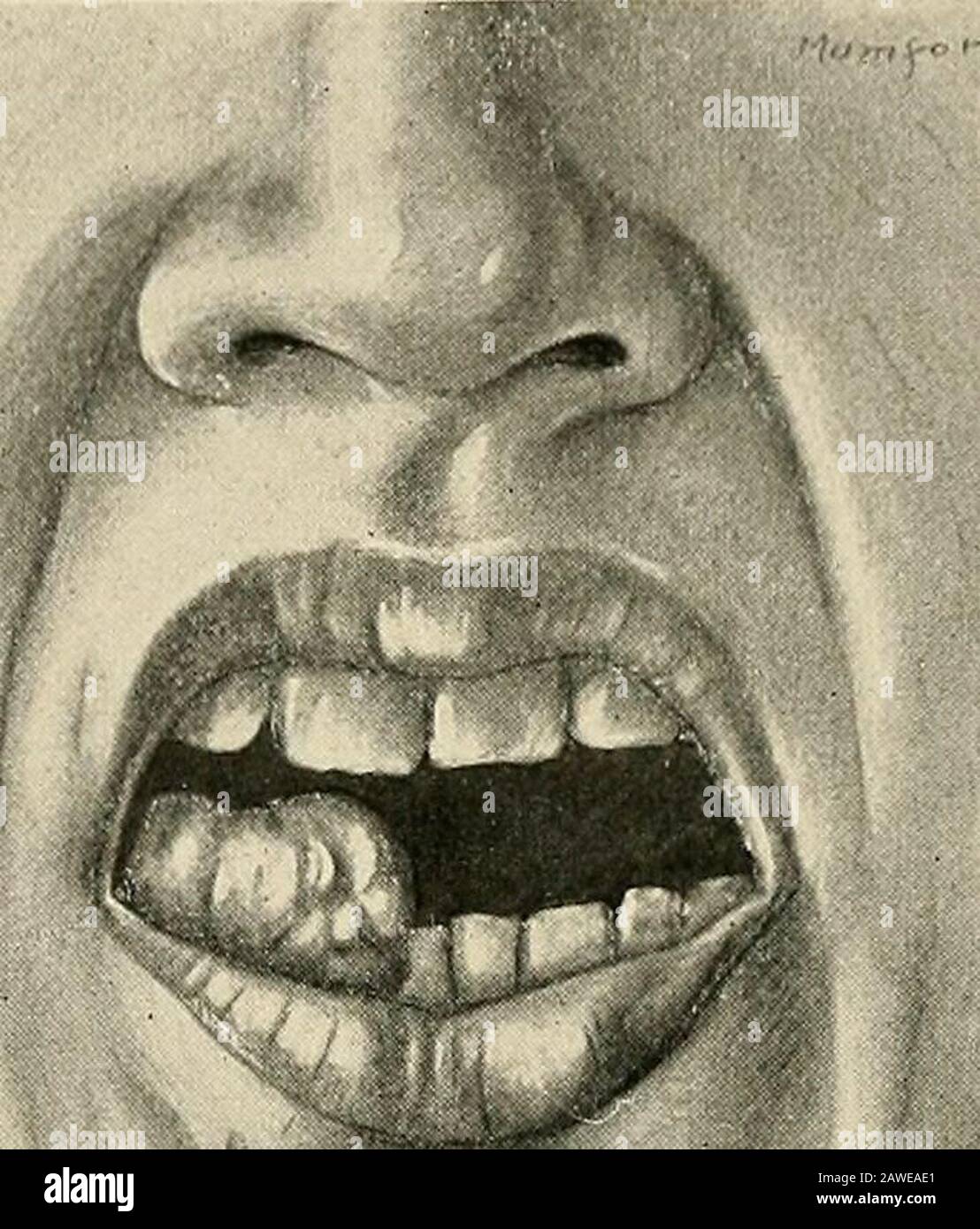 The practice of surgery . and tendsto envelop the bone. It appears at the edge of the teeth as a curious pig- Fig. 371.—A follicular odon-toma from the right half of themandible of a boy aged fourteenyears (Bland-Sutton in KeensSurgery). TUMORS OF THE JAWS 563 merited excrescence, and is the only form of pigmented sarcoma thatis not exceedingly malignant. If untreated, it spreads gradually so asto involve largo portions of the jaw, and causes falling of the teeth untileventually, and after many years, it kills the patient through encroach-ment upon, and destruction of, important organs. It is Stock Photo