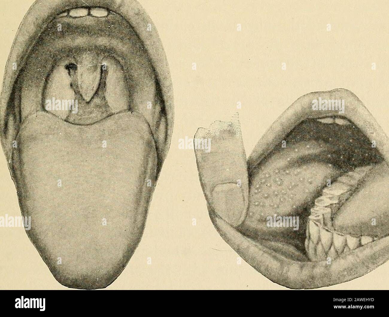 Oral surgery; a text-book on general surgery and medicine as applied to dentistry . Fig. 21.—Strawberry Tongue. Fig. 22.—Follicular Tonsilitis.. Fig. 2.3.—Diphtheritic Throat. Fig. 24.—Kopliks Spots. (Palisade Mfg. Co.) 138 MOUTH LESIONS ing catarrhs of the respiratory tract. Catarrhal inflamma-tions of the skin may alternate with those of the mucousmembranes, the one being active while the other is held inabeyance. This view is upheld by Broca, and it may bedue to the same pathological law which governs the sub-sidence of an inflammation in one organ while it is activein another. The absence Stock Photo