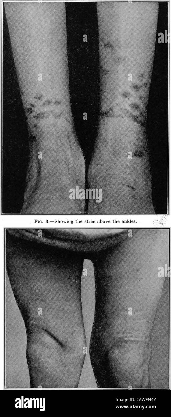 Clinical and pathological papers .. . Fig. 2.—Showing the strite about the knees. those on the left, making a total of forty-two. The positions ofthese striae are seen in the accompanying pictures (Figs. 2 and 3).They were a delicate pink color, in marked contrast to the surround-ing skin, and were painless, causing the patient no inconveniencewhatever. There were no sensory disturbances in this case. Dur-ing the patients prolonged stay in bed he grew about four inches inheight, and it seems to me that the most reasonable explanation of thestriae is the stretching of the skin from the rapid gr Stock Photo