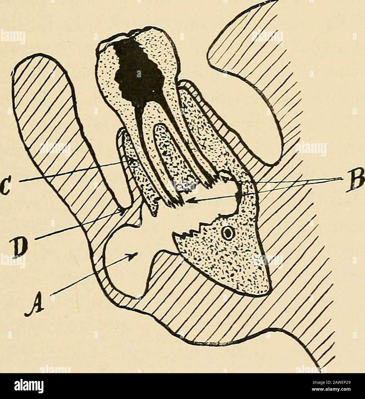 Oral surgery; a text-book on general surgery and medicine as applied to dentistry . Fig. 16.—Abscess, a, antral cavity; h, naso-antral septum; c, membranousfloor of the antrum; d, abscess cavity ready to rupture into the antrum; e,root of tooth denuded and cause of disease.. Fig. 17.—Alveolar Abscess of the Mandible. A, abscess cavity; B, roots oftooth; C, external alveolar plate to be removed with tooth; D, point ofincision. Treatment.—Assuming that the dentist has made an ef-fort to close an alveolar fistula by cutting off the rootof the tooth and by draining through the tooth, and 122 ALVEO Stock Photo