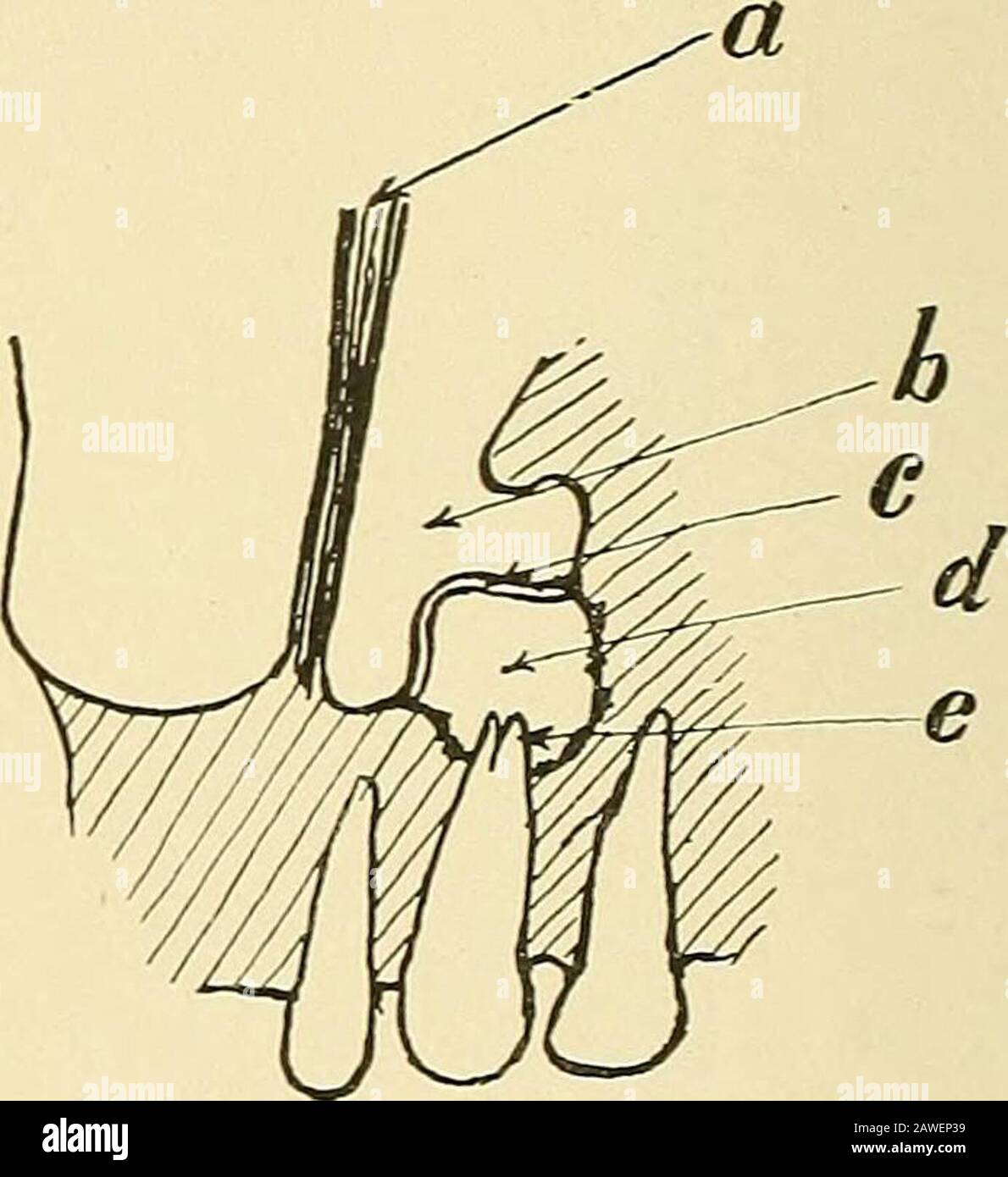 Oral surgery; a text-book on general surgery and medicine as applied to dentistry . Fig. 14.—The Most Common Alveo-LAK Fistula of the Maxilla. Usu-ally persists for years iintil the toothIS extracted; and the bone on the buc-cal side removed. Fig. 15.—Method of Establish-ment of Naso-oral Fistula, a,nasal septum; b, nasal cavity; c, mem-branous floor; d, abscess cavity; e,denuded root of tooth. of the antrum is destroyed, yet the antral cavity is notentered because the membranous floor is still intact. Inalveolar abscess of the mandible it is not uncommon forthe abscess to break through the ch Stock Photo