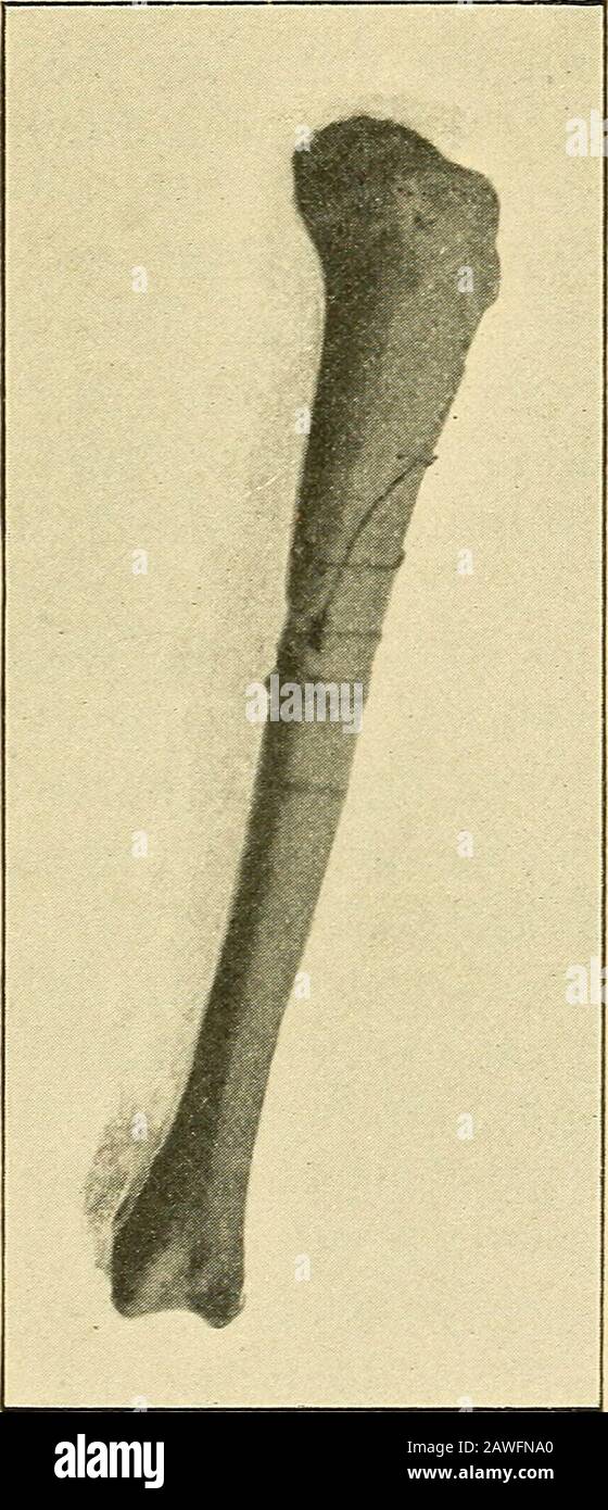 Wounds in war : the mechanism of their production and their treatment . Fig. 62. Fracture of tibia by Lee-Met-ford bullet at fifty yardsrange ; entrance side.—Netley Museum. Fig. 63. Exit side in case shown in Fig. 62.—Netley Museum. the near side, with fissures extending for several inches upand clown the shaft, and slight loss of substance in thewall of the bone on the far side, with fragmentation intolarge and small pieces (figs. 62 and 63). One or both bones may be fractured at the same time, orthe bullet may pass between them without touching either. 246 . WOUNDS IN WAR The bones may be g Stock Photo